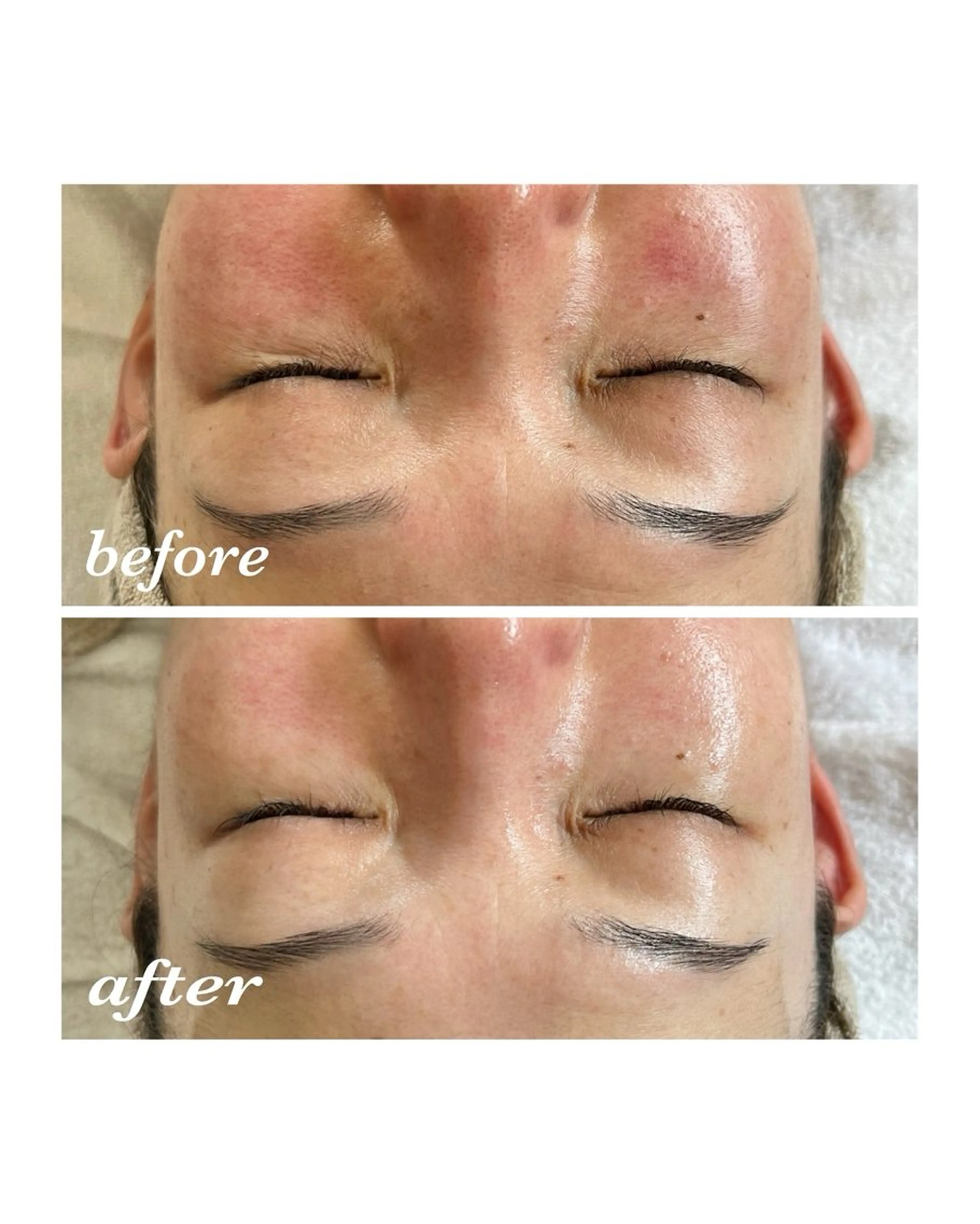 💎もちっと艶肌&リフトアップ💎ララピール+ミハツウェーブの写真