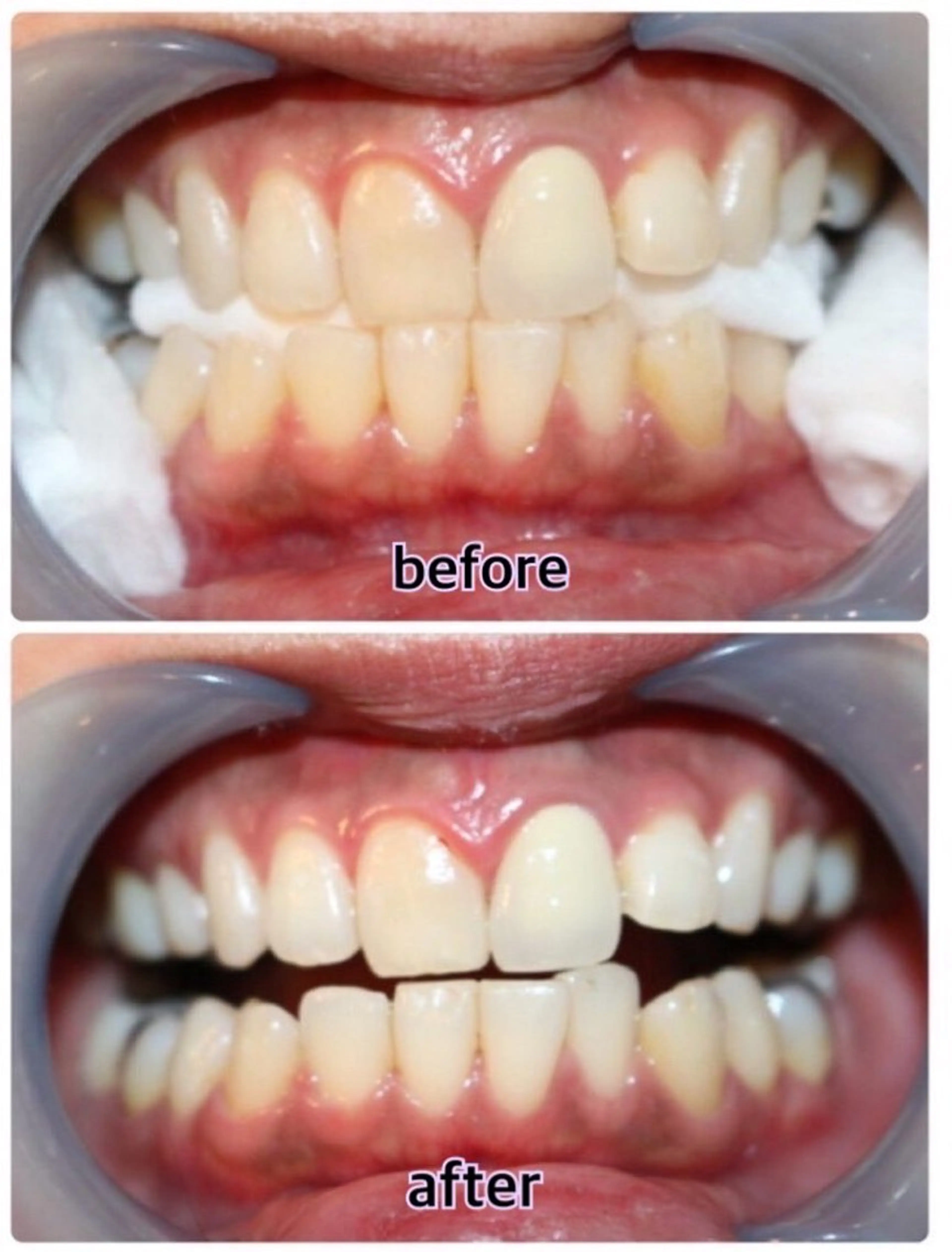 【冬準備企画】お試しセルフホワイトニング30min ※口コミお願いしますの写真