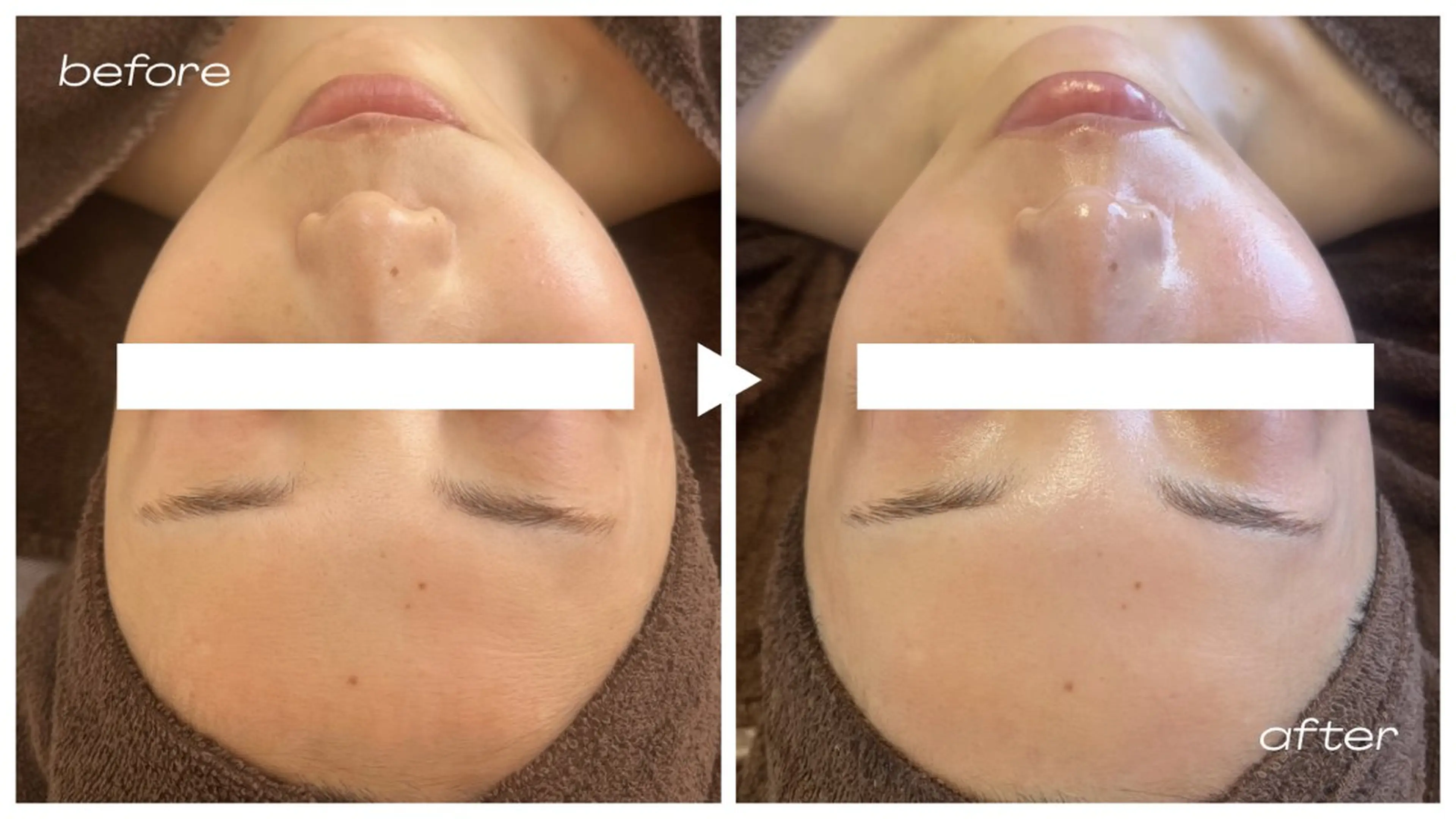 脱毛 1st｜フェイシャル エステ専門店のエステ・リラクイメージ