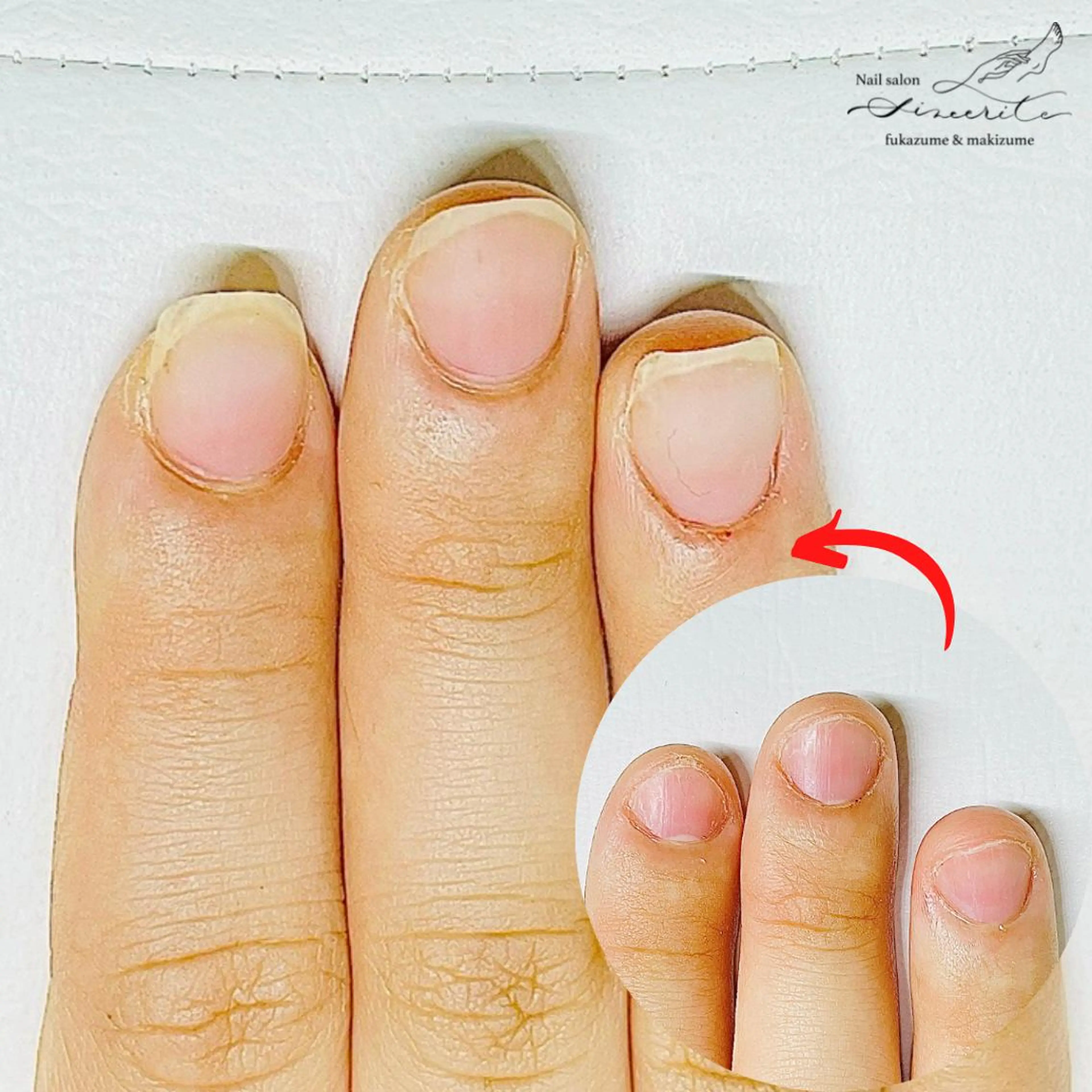 ネイル 深爪・巻き爪 専門サンセリテのネイルデザイン