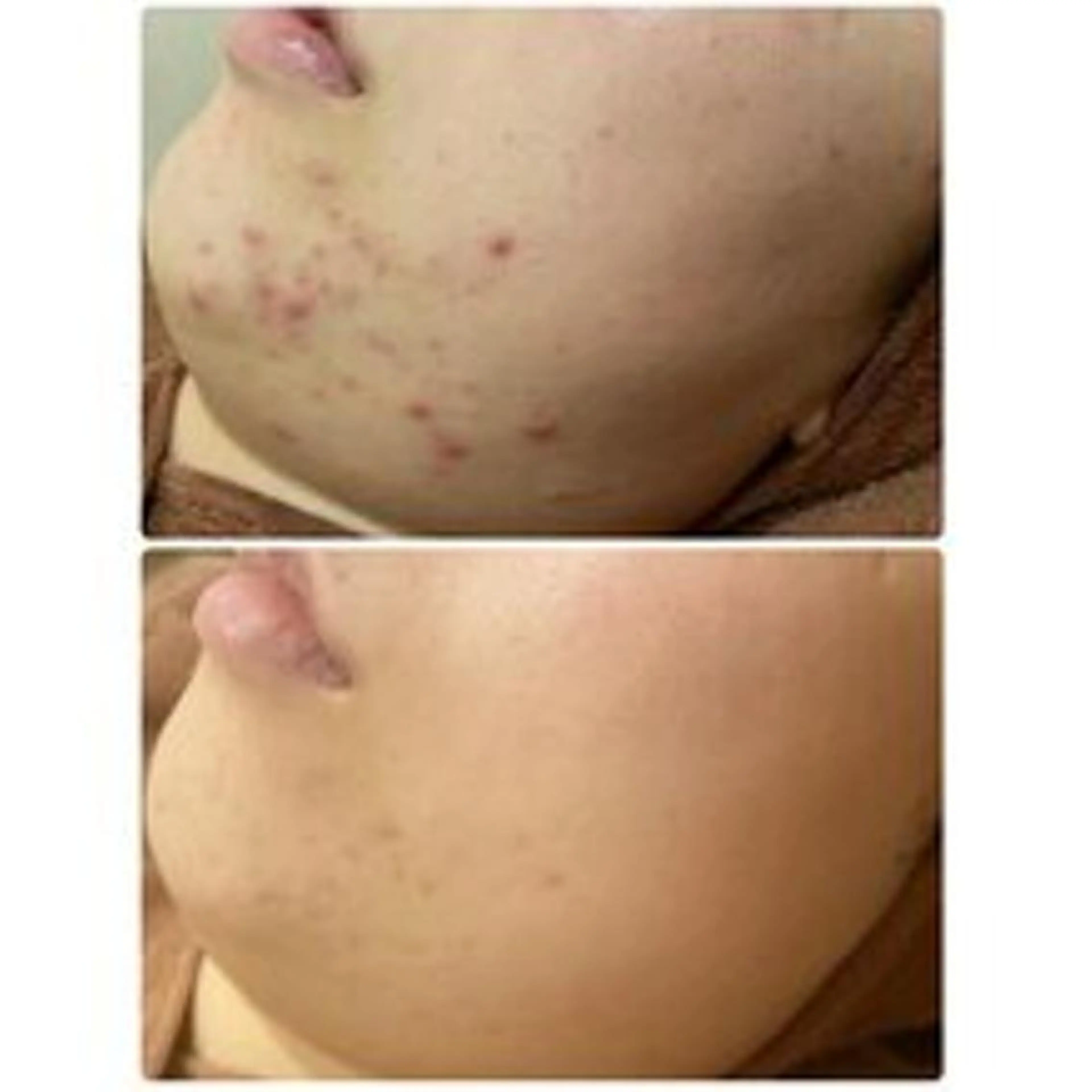 学生ニキビ改善🍀 優しい肌質改善のエステ・リラクイメージ