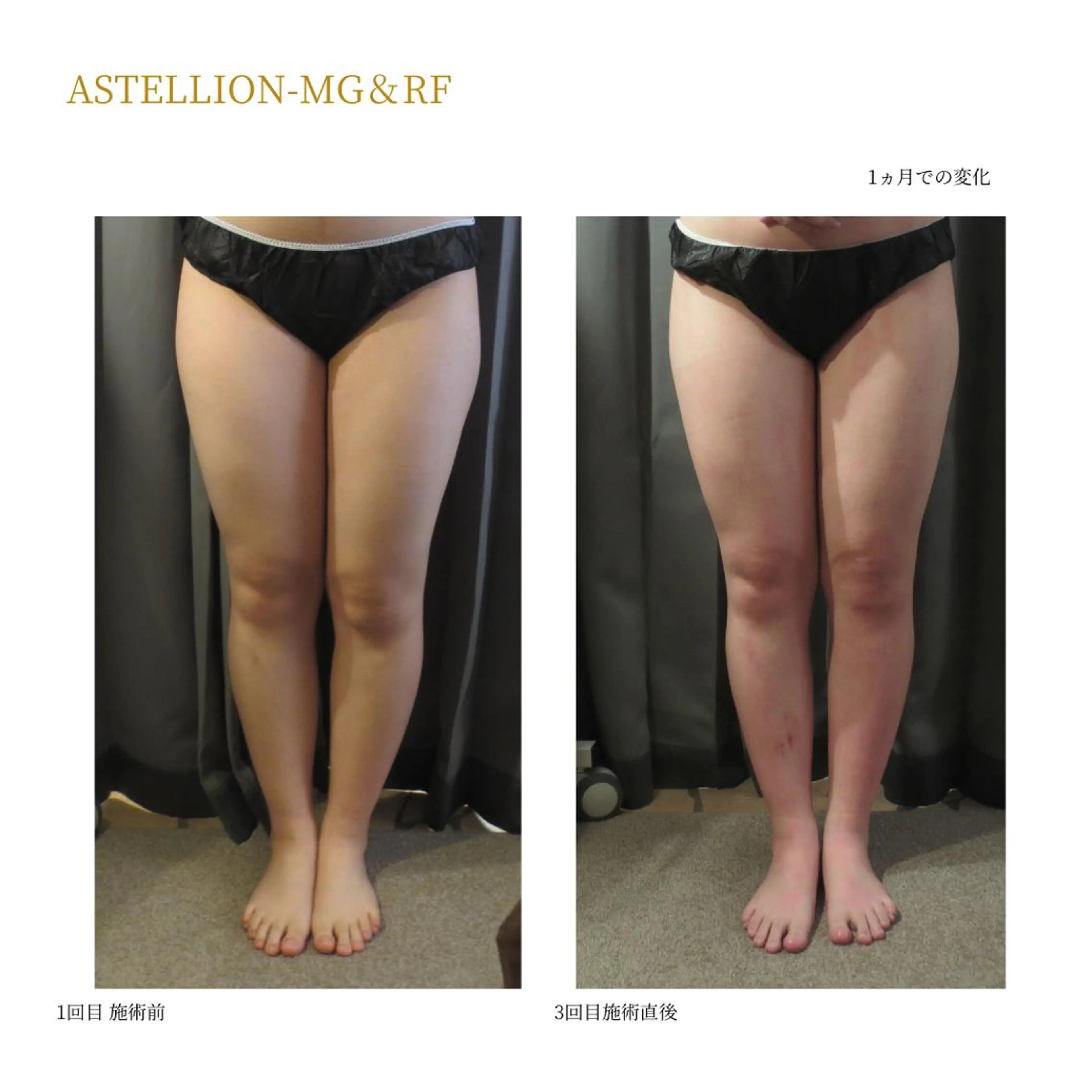 1回で変化を実感！！痩身コース体験　120分の写真