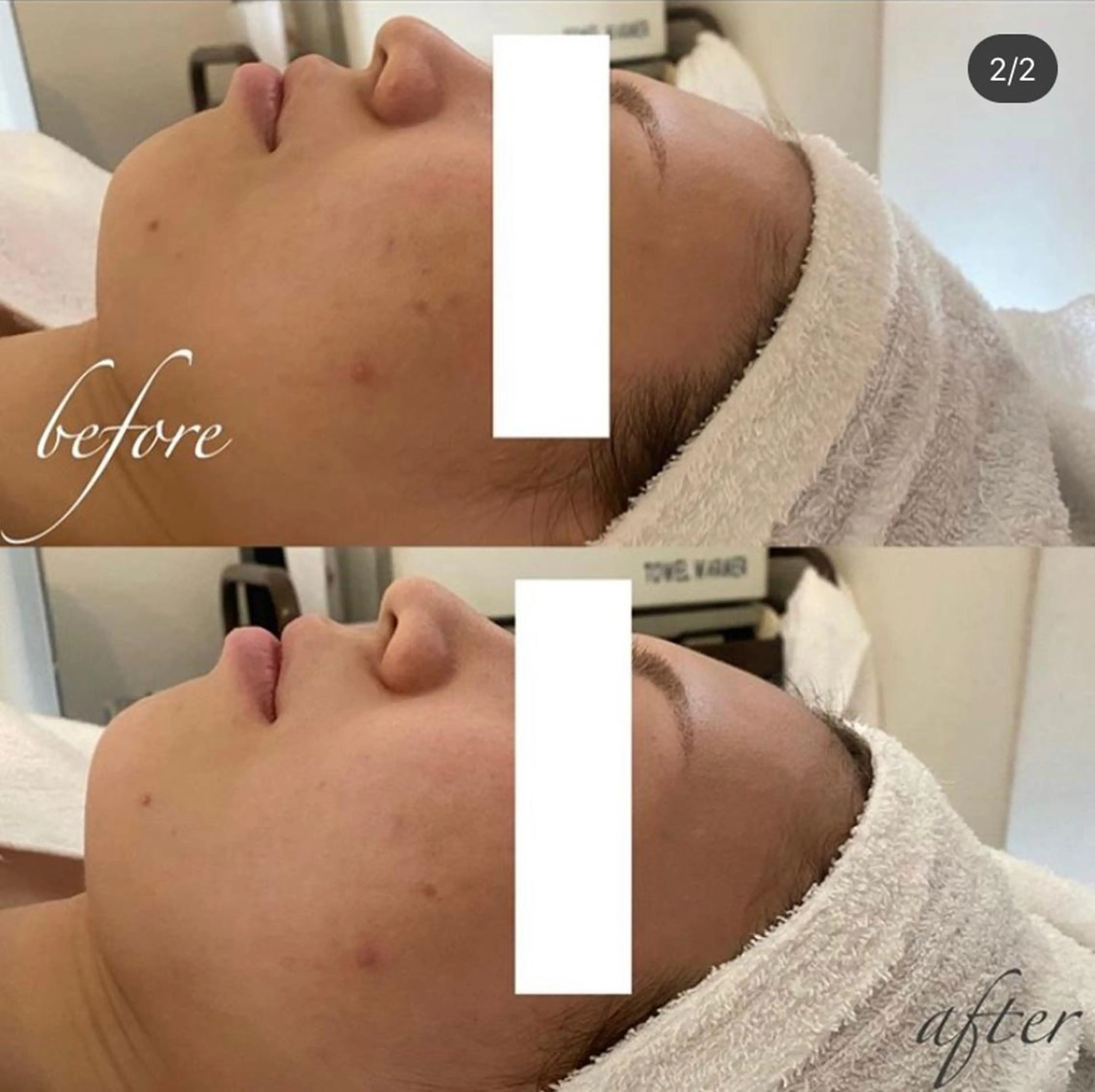 エステ リラク 毛穴/ピーリング ララピール/POLAのエステ・リラクイメージ