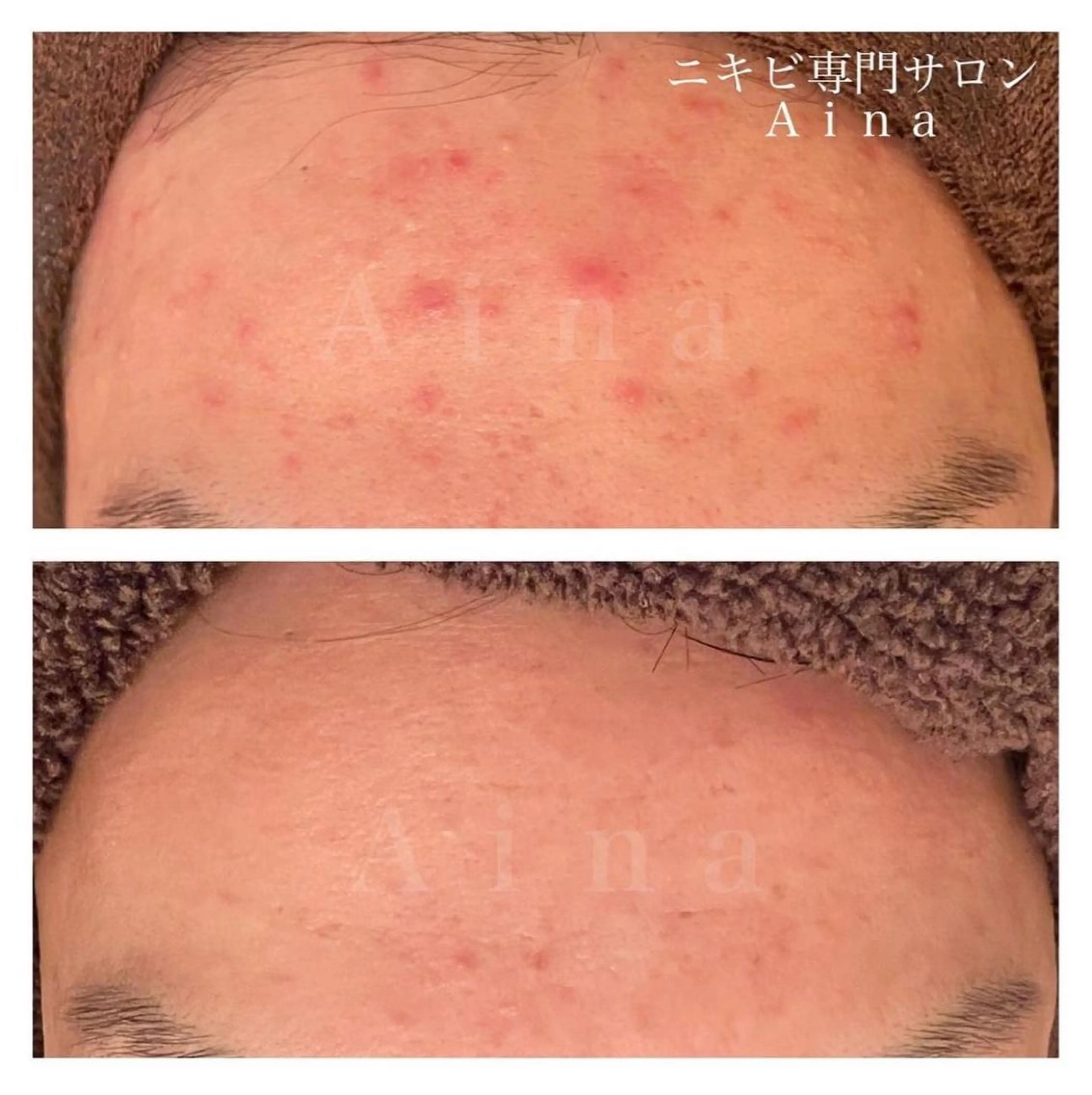 セミロング カラー パーマ ヘアアレンジ メンズ キッズ ネイル マツエク・マツパ アイブロウ 赤色 エステ リラク ニキビ跡専門サロン Ａｉｎａのエステ・リラクイメージ