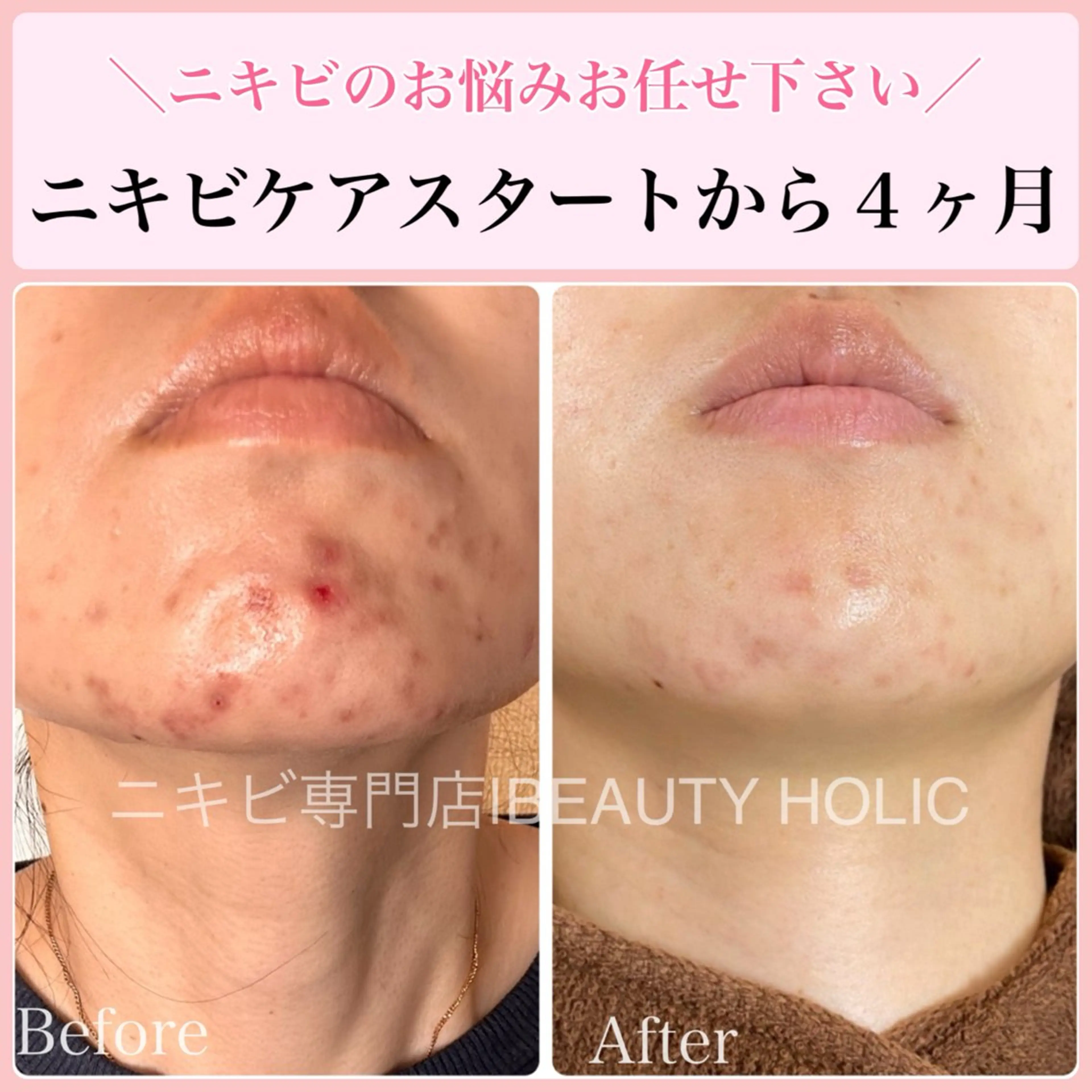 エステ リラク ニキビ・ 肌荒れ専門店のエステ・リラクイメージ