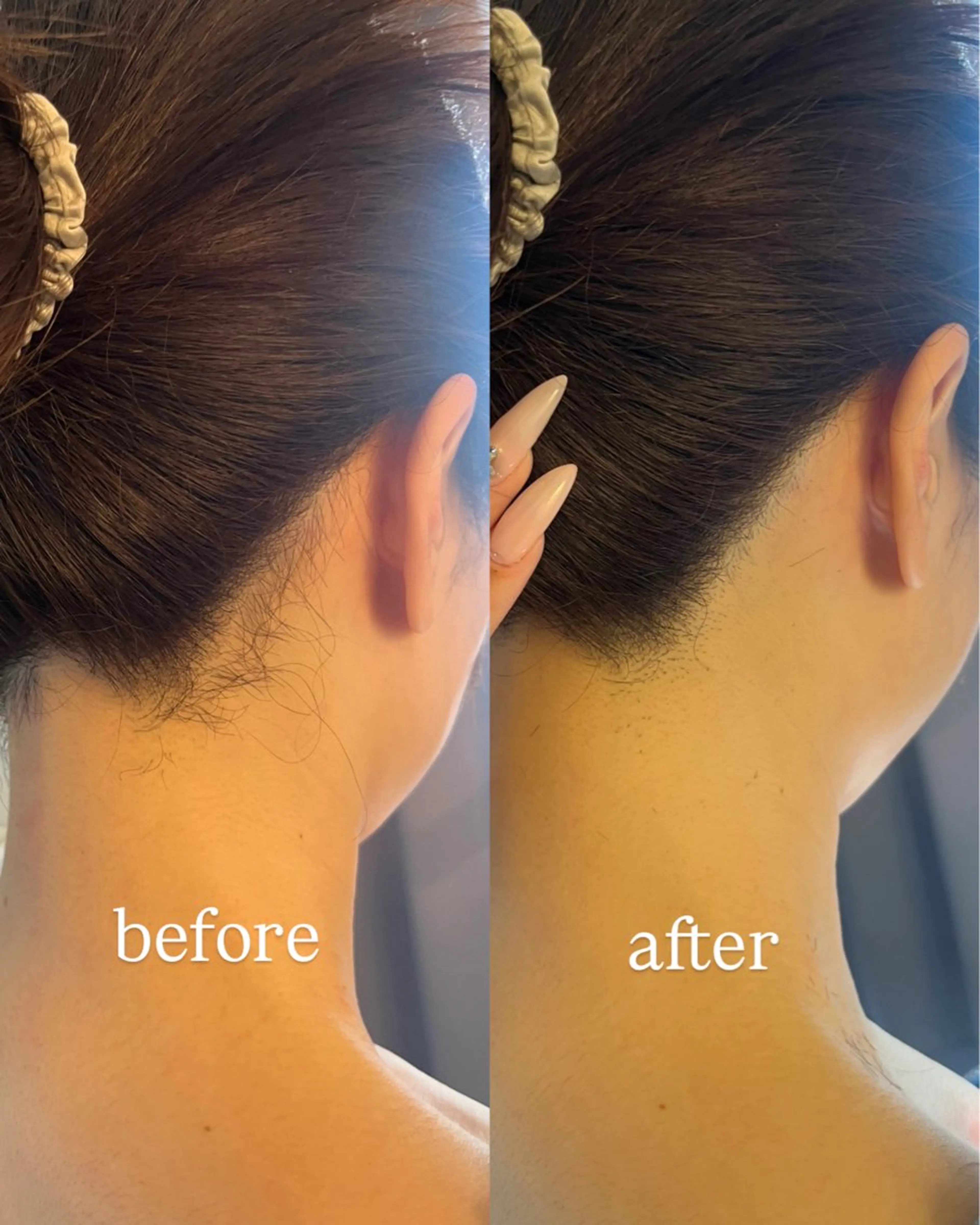 脱毛 うなじ脱毛/美肌脱毛 LABELのエステ・リラクイメージ