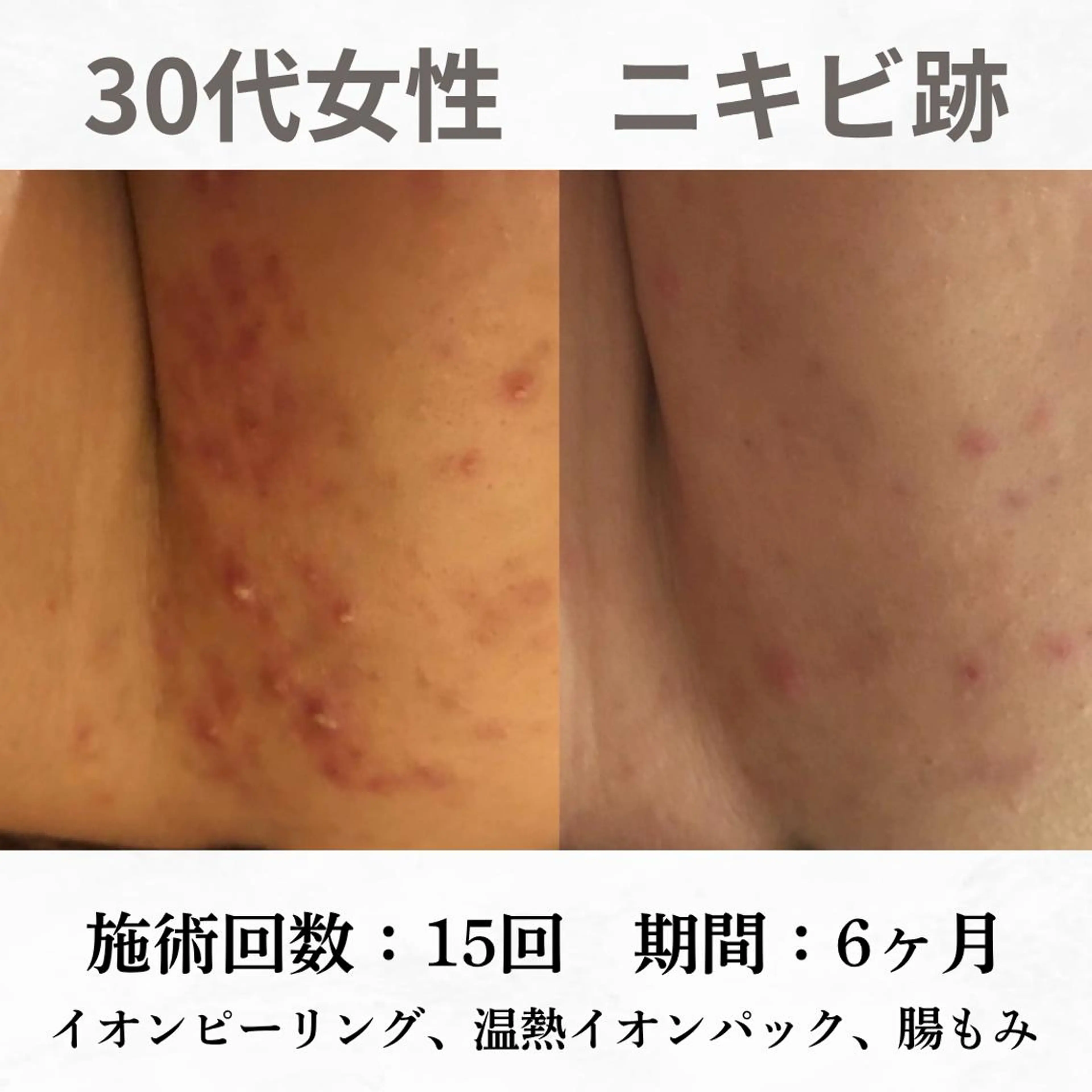 重度ニキビ専門🌷 ダウンタイムなしのエステ・リラクイメージ