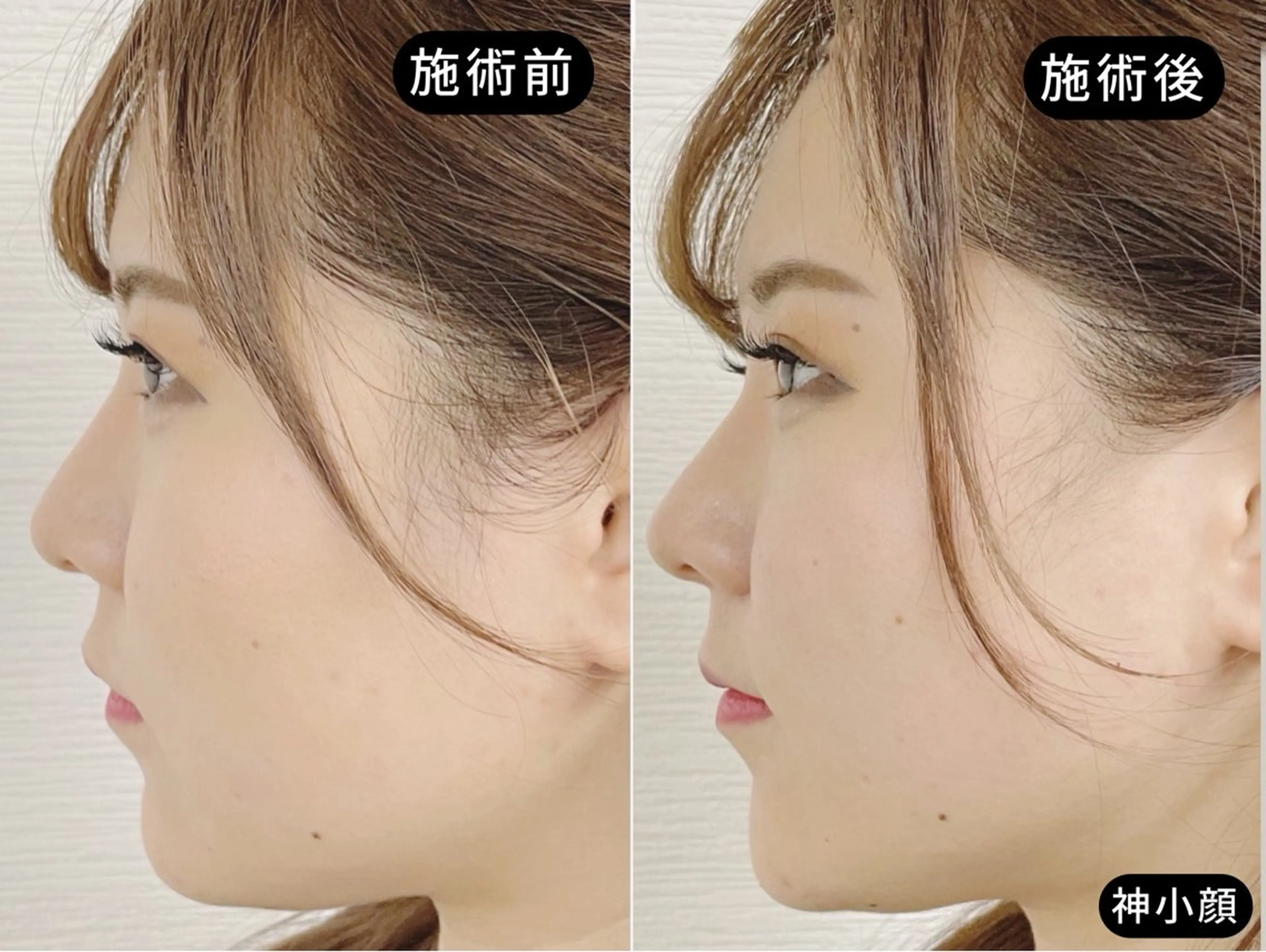 【横顔革命🔥】二重アゴ×エラ集中｜美容鍼×特殊EMS 70分の写真
