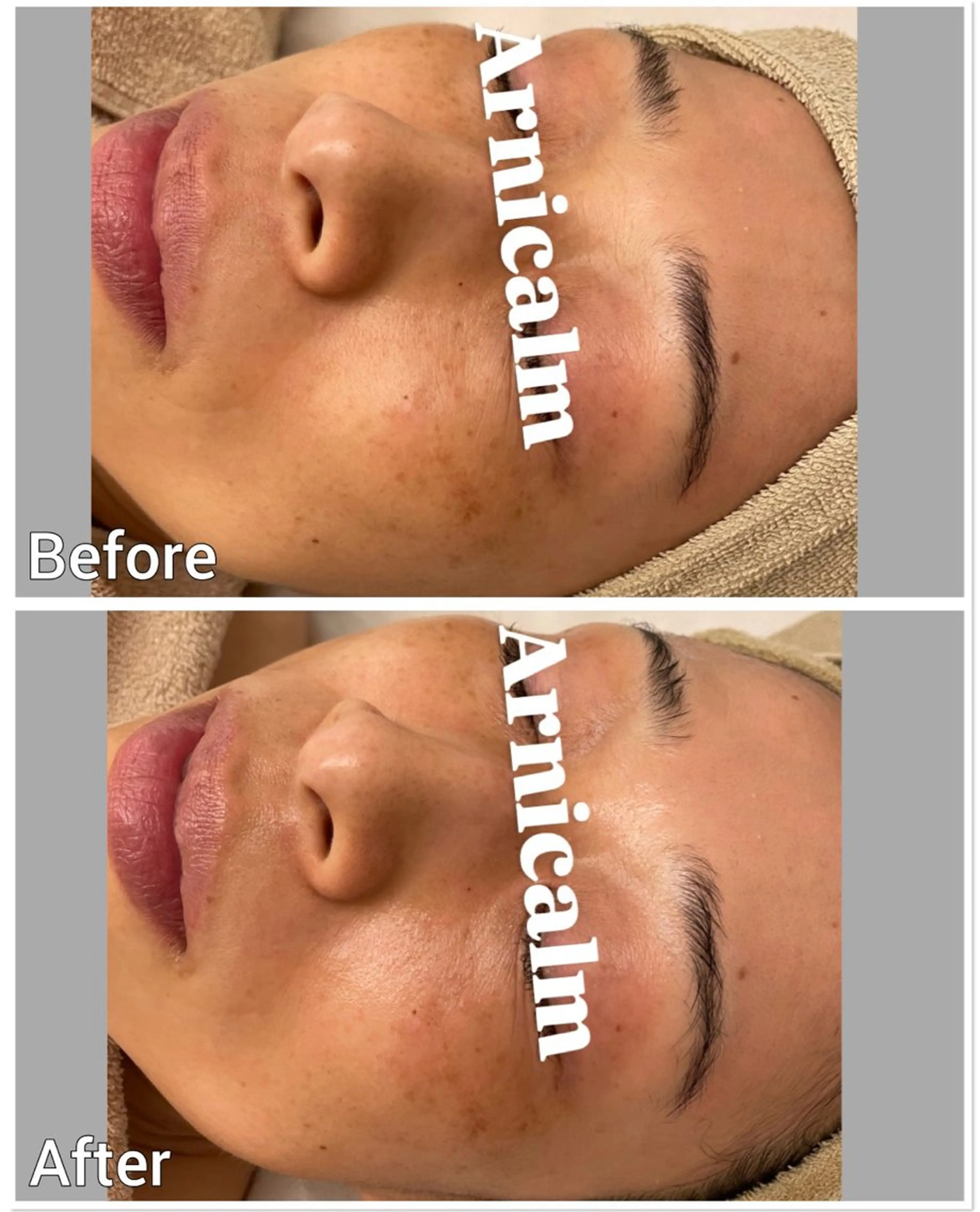 エステ ハーブピーリング 肌再生ピーリング/のエステ・リラクイメージ