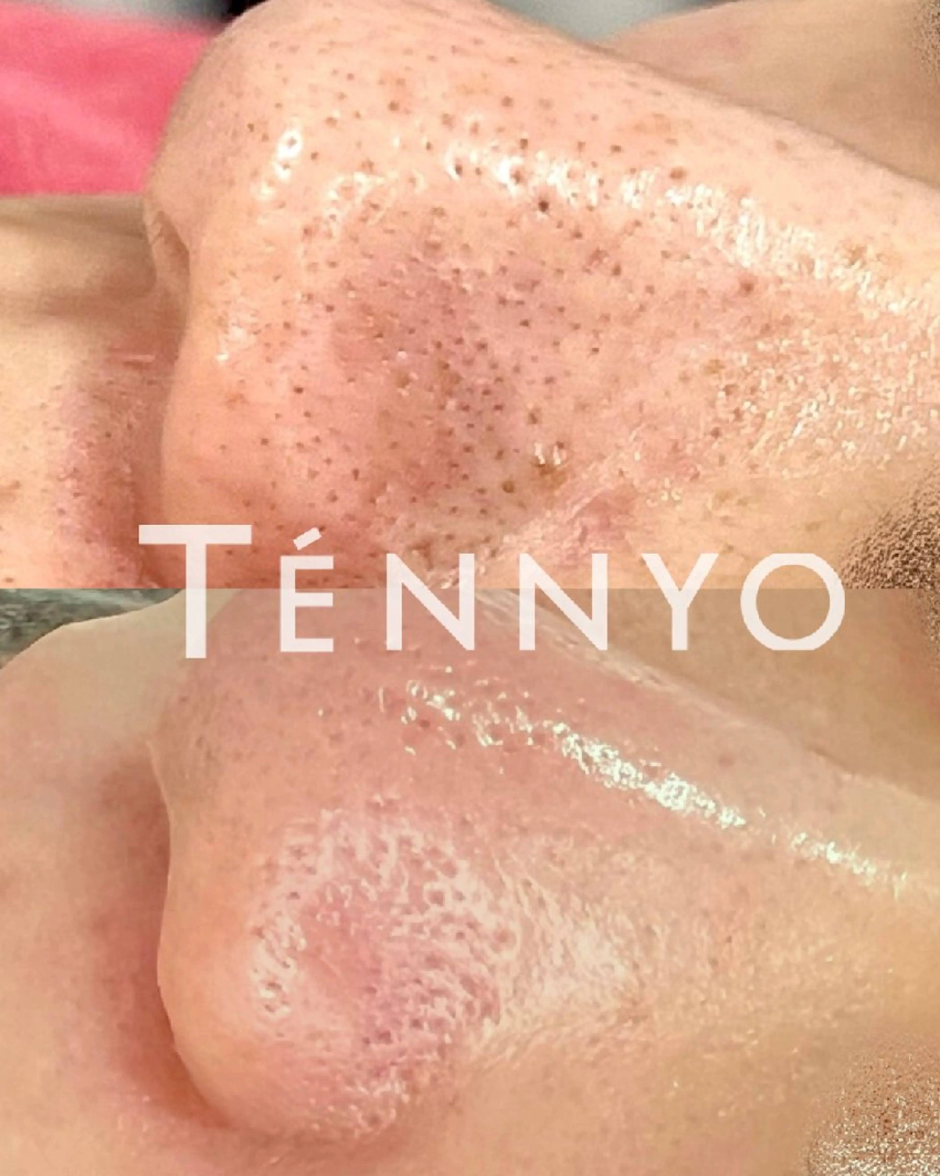 ミニモ限定価格【黒ずみ・角栓ごっそり✨】毛穴洗浄・毛穴エクストラクション全顔/通常価格￥9,000→￥5,800の写真