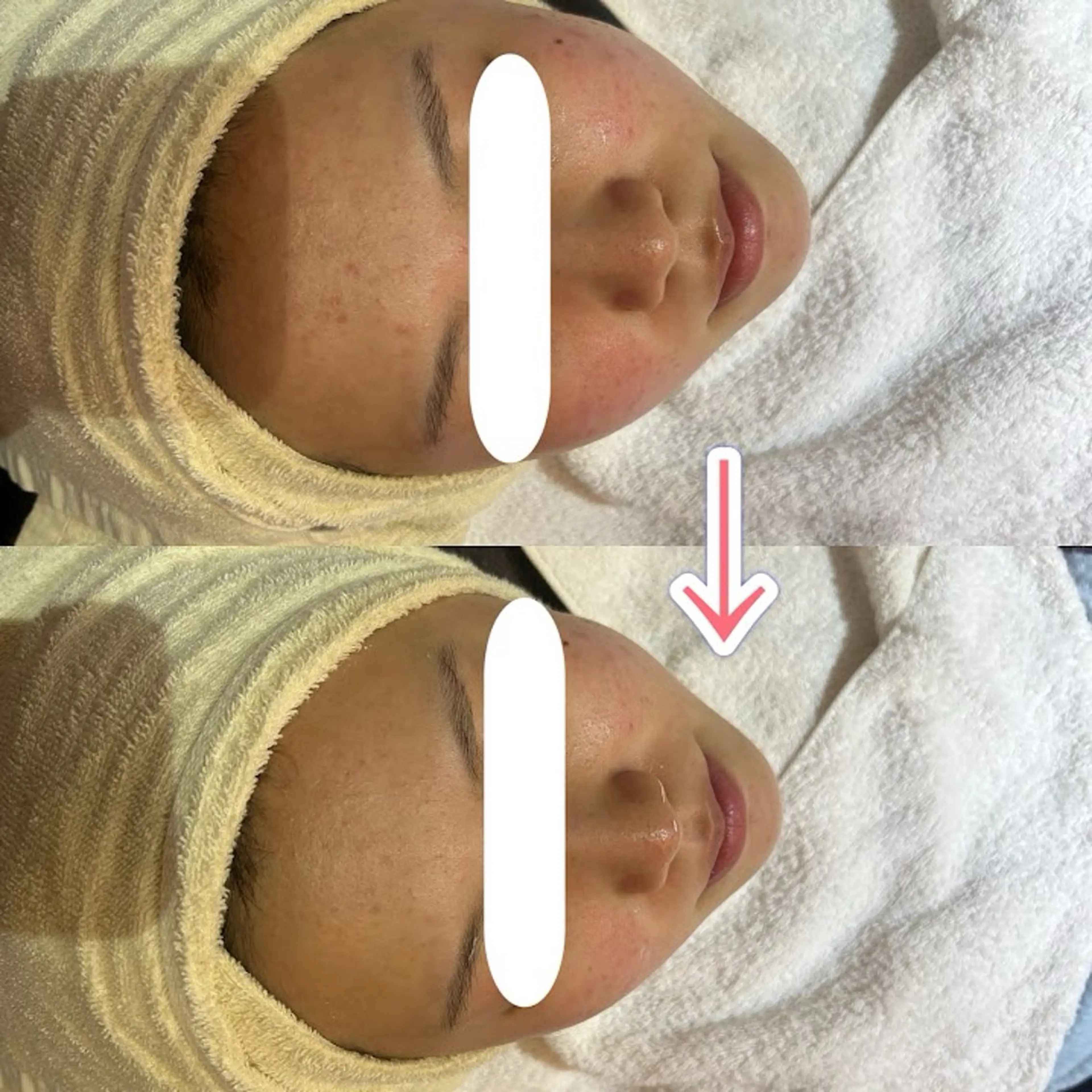 【ツルんっ‼︎と卵肌】徹底毛穴洗浄🎵+角質除去効果のあるモデリングパックの写真