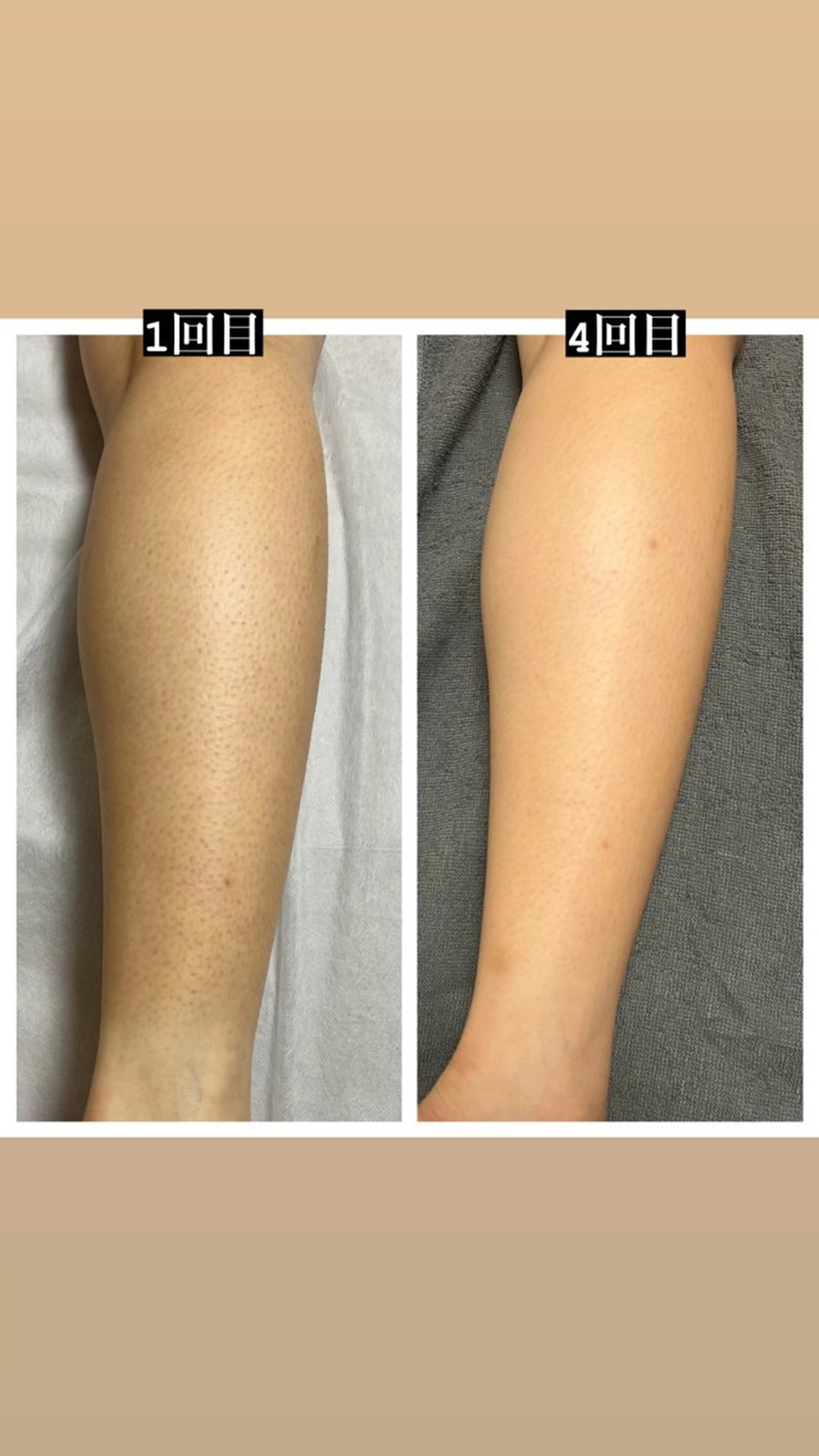 1月4・5・6・7・8・10・11・12・13・15・16・17・限定🌈表示価格より10%オフ ワキ・うで・あし脱毛✨の写真