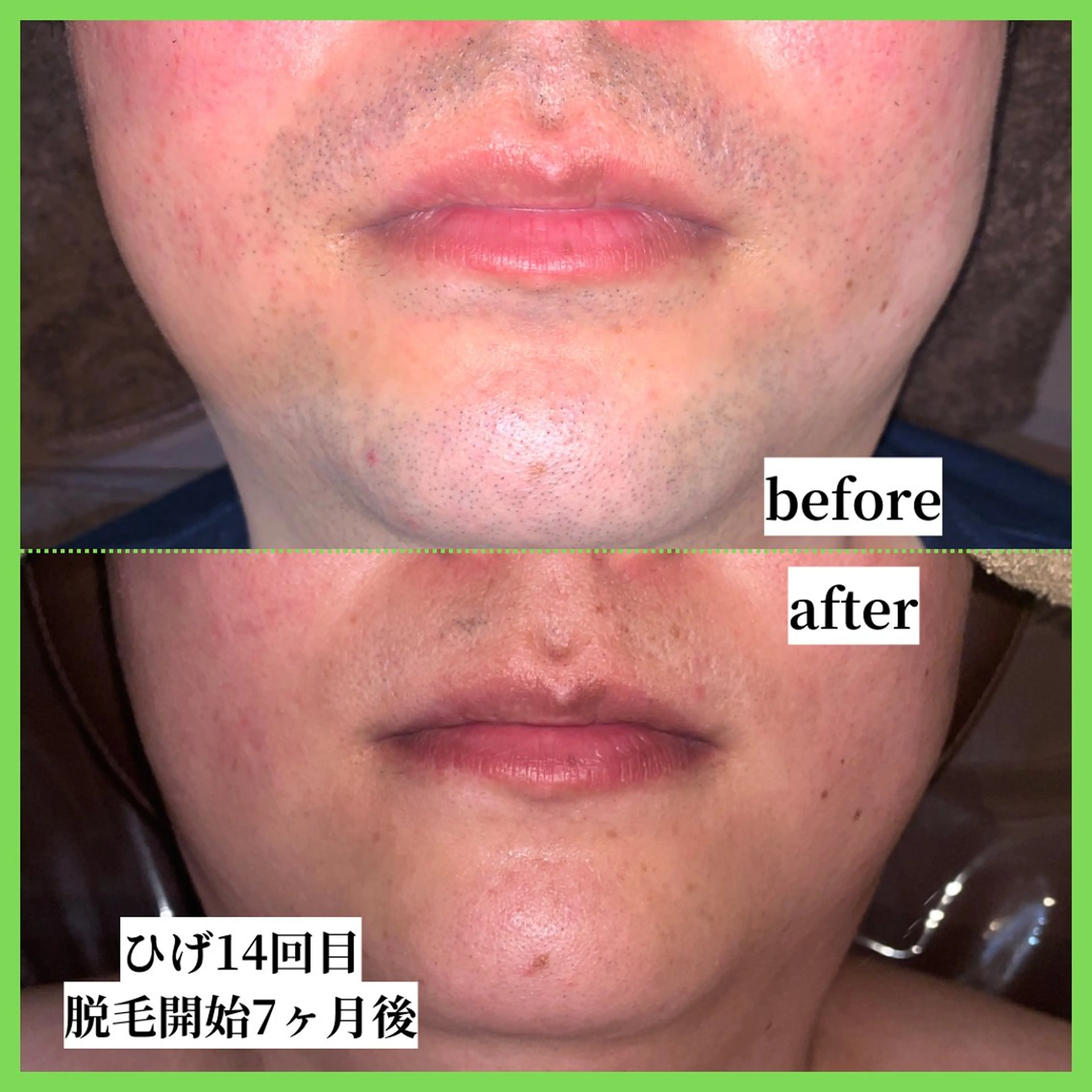 メンズ 脱毛 天神【効果重視脱毛】 YouMakeのエステ・リラクイメージ