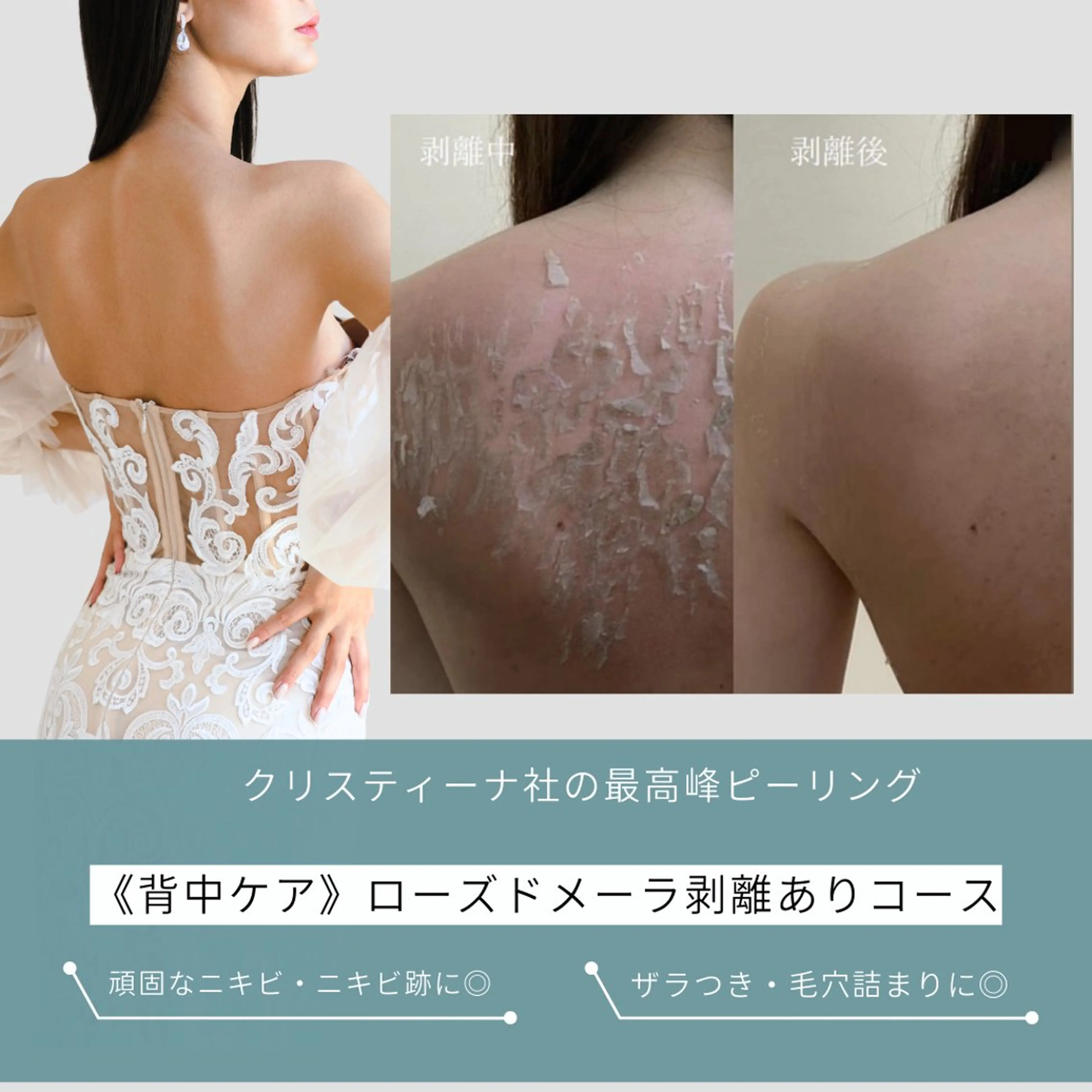 【背中ケア】剥離ありハーブピーリング(ローズドメーラ)で根本から集中改善◎※7​〜​14日間の本格集中改善プログラムの写真