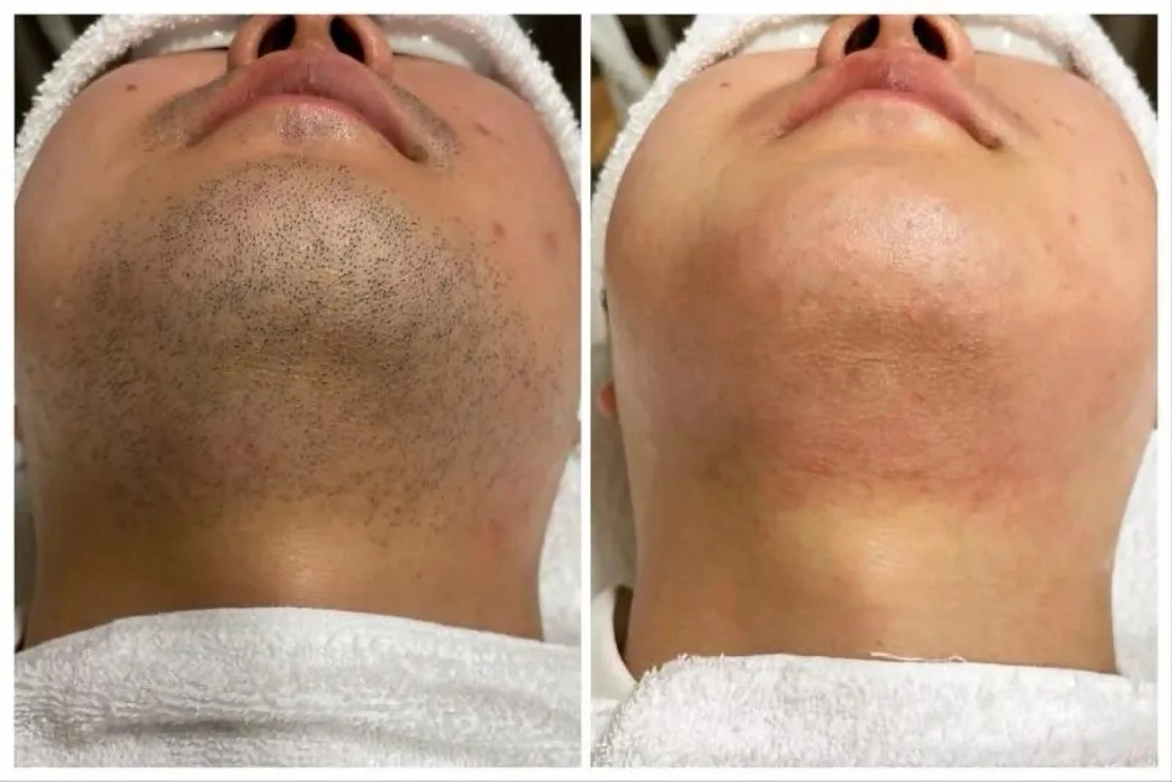 【メンズ　ヒゲ脱毛¥3000】　　痛くない/白髪や剛毛にも対応/カミソリ負けに/メンズカットの写真