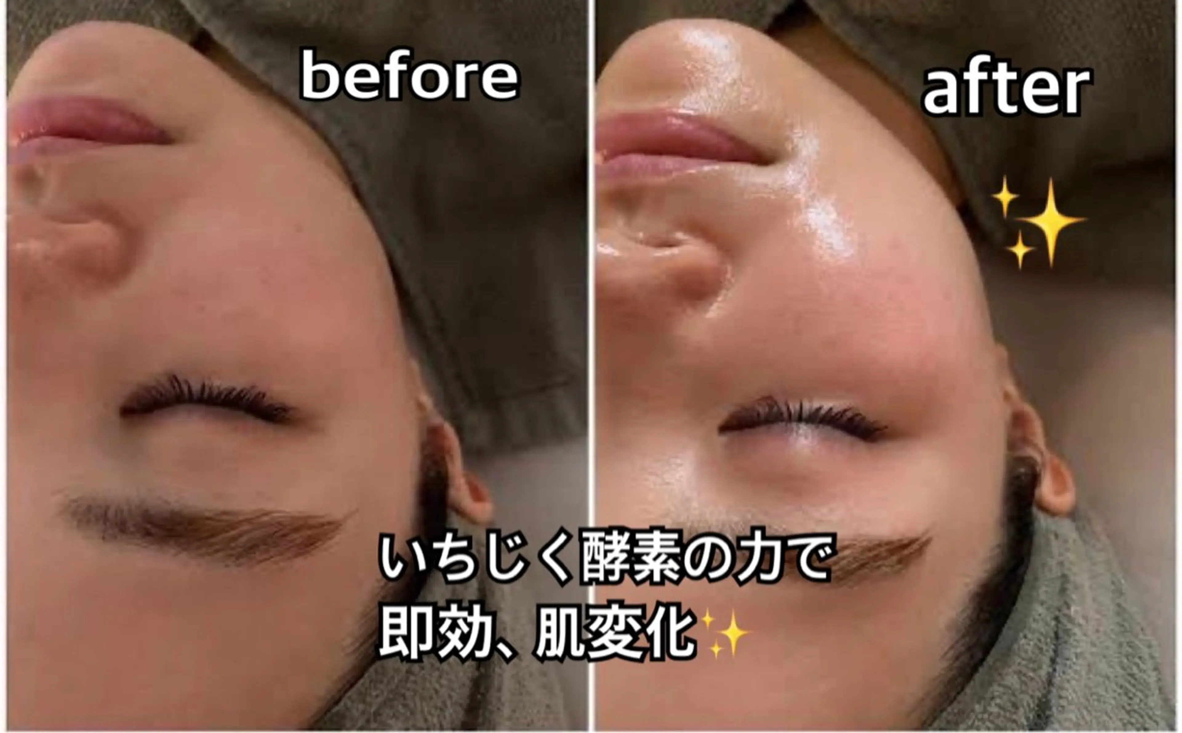 【🫧目指せ毛穴レス✨️】いちじくピーリング＋2種の毛穴洗浄機器フェイシャルの写真