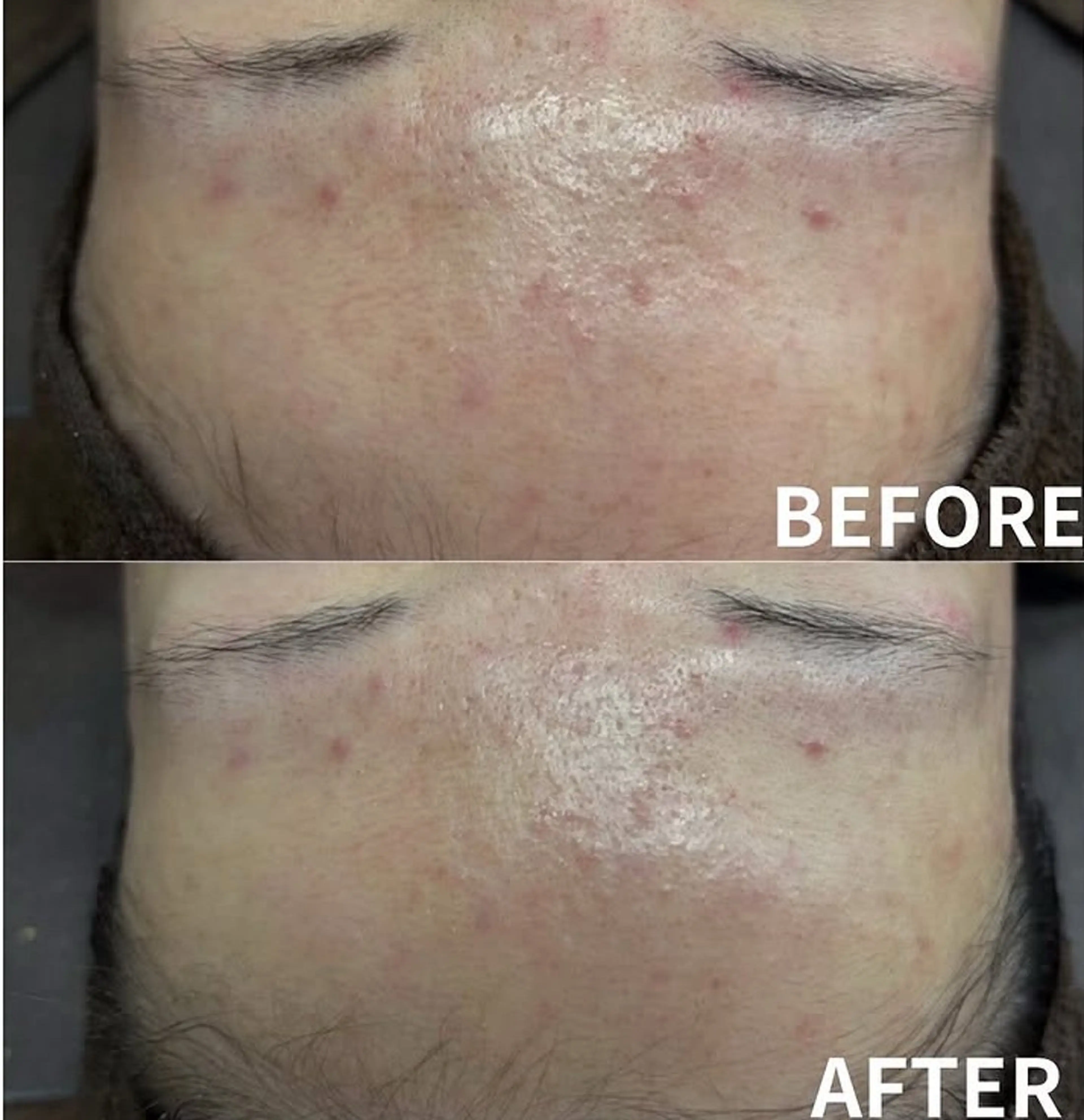 次世代ハーブトリートメント🌿肌質改善、シミ、シワ、ニキビ肌、ニキビ後、毛穴、黒ずみ、美白の写真