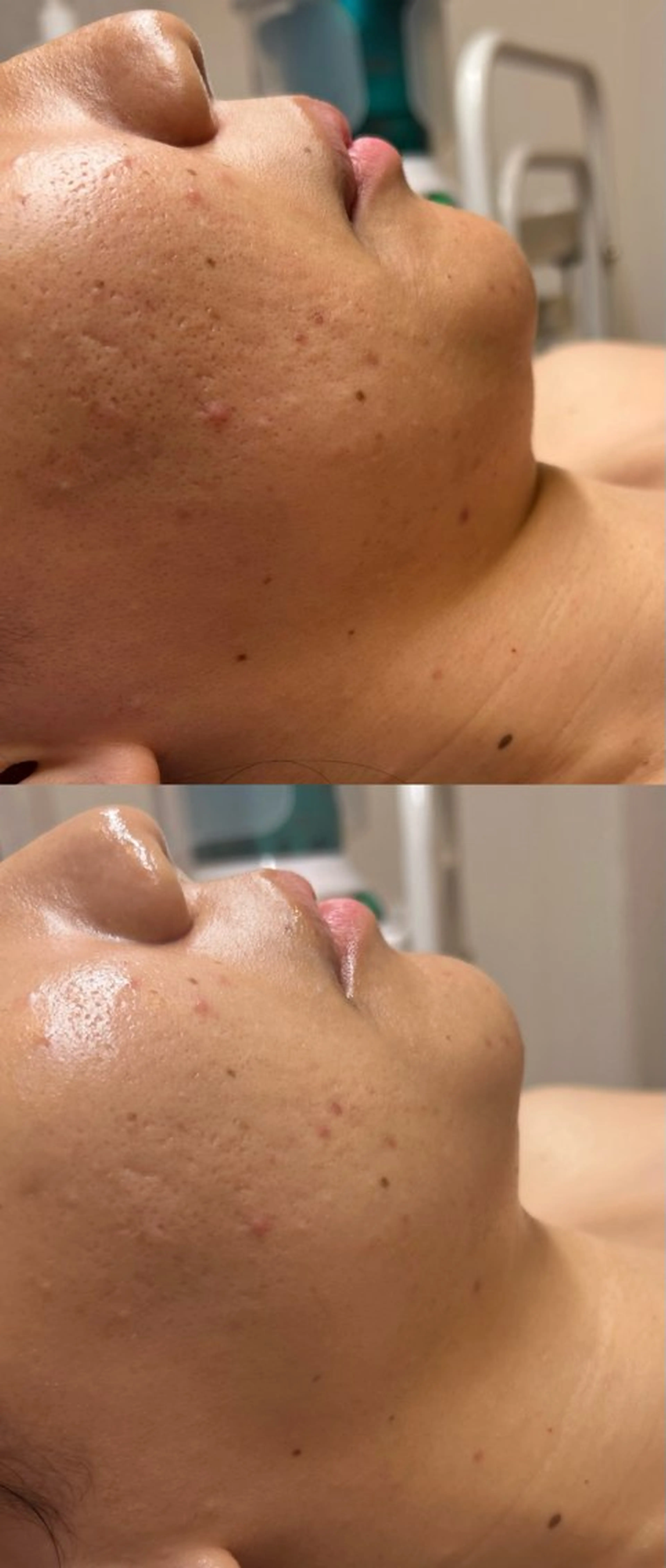 毛穴洗浄＋ハーブピーリング🌿の写真