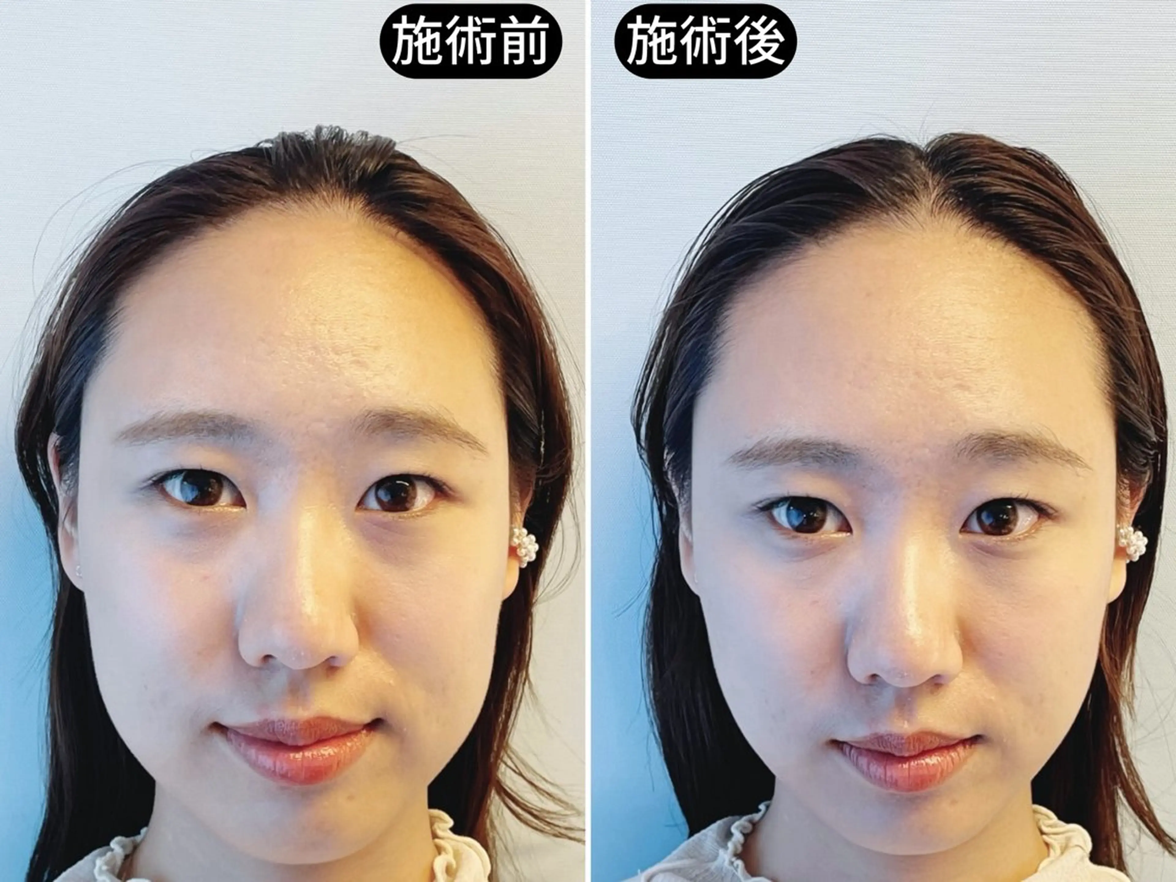 エステ リラク 渋谷 小顔美容鍼 専門サロン YZのエステ・リラクイメージ