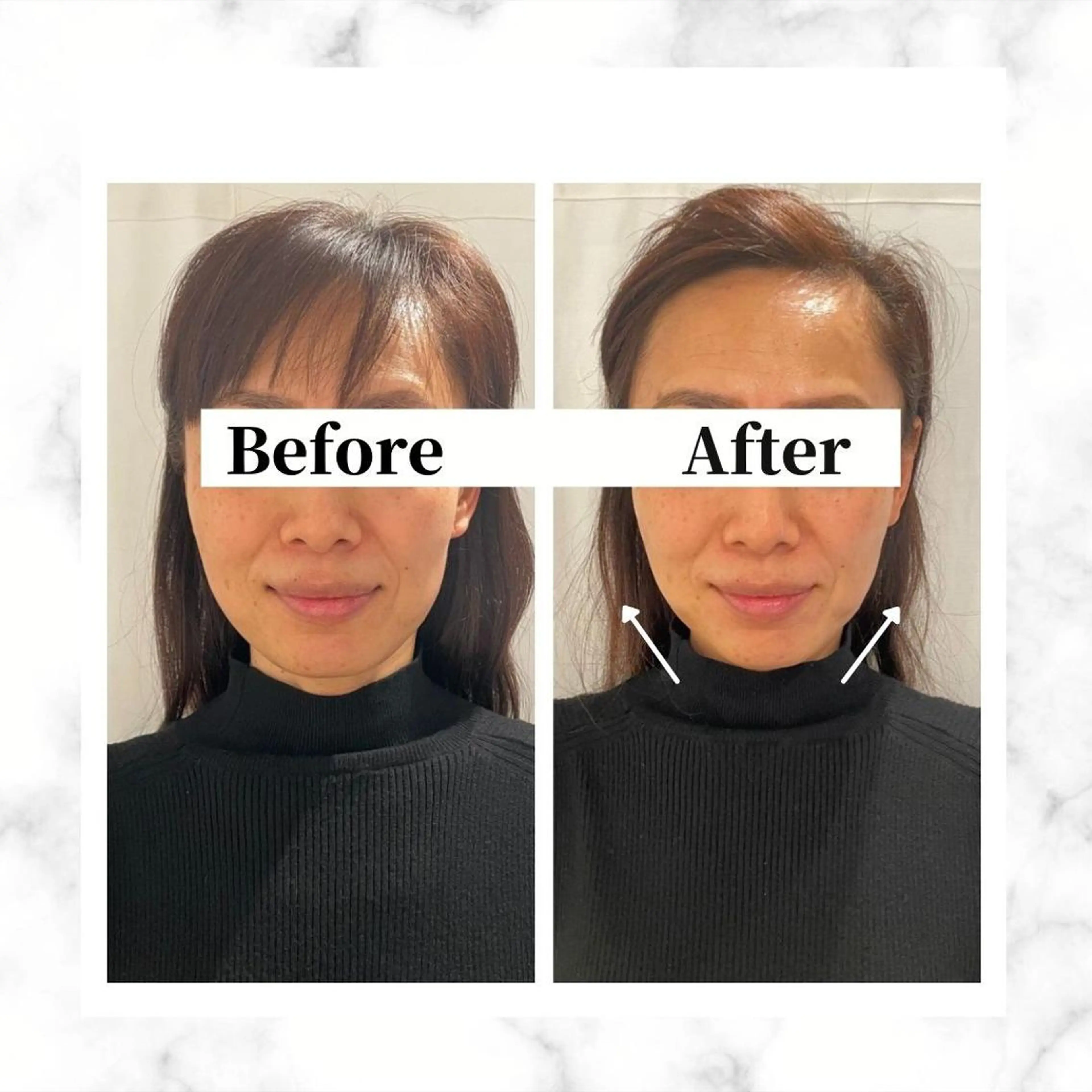 エステ リラク 12Dハイフ💗 最強小顔のエステ・リラクイメージ