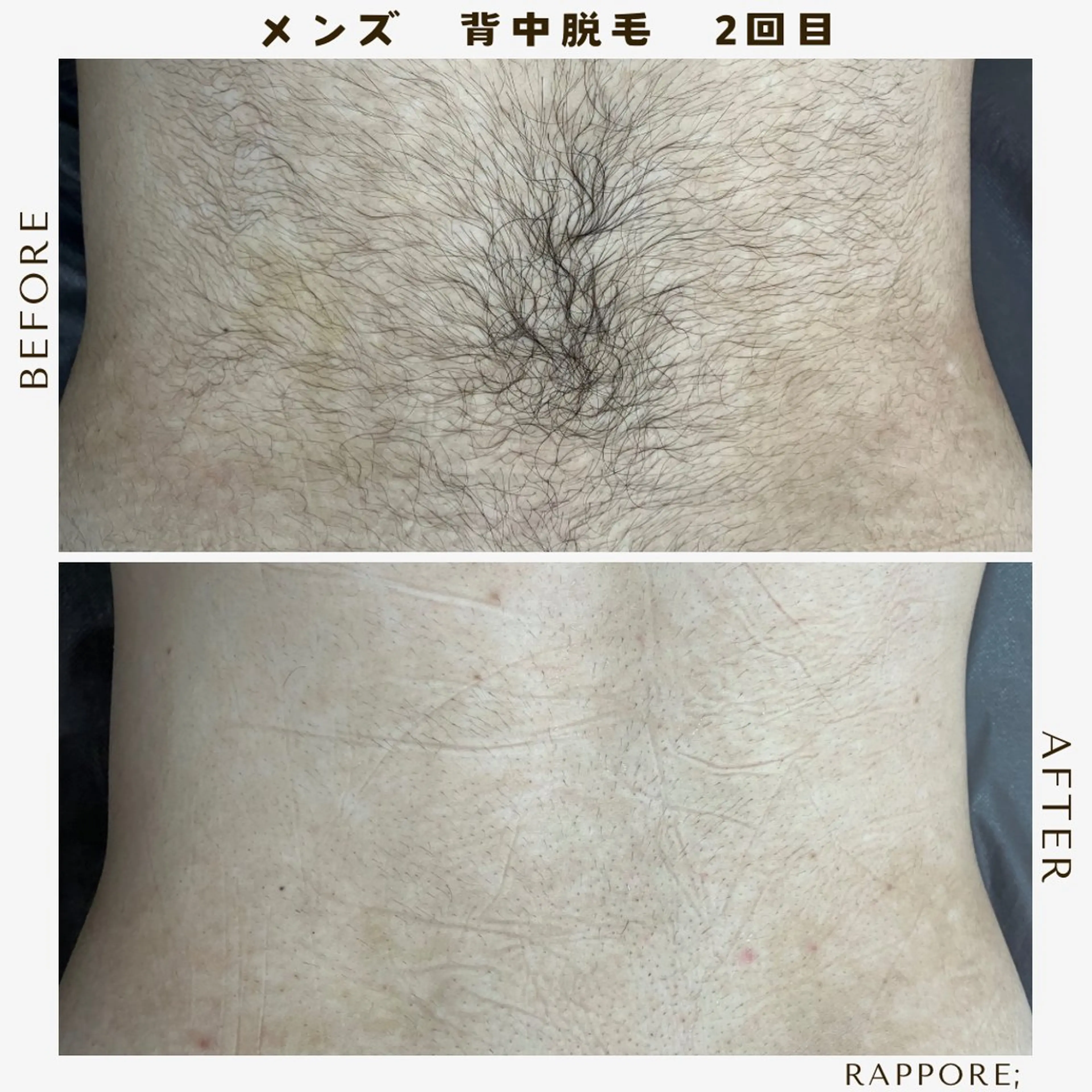 メンズ 脱毛 Rappore; 心斎橋　みずきのエステ・リラクイメージ
