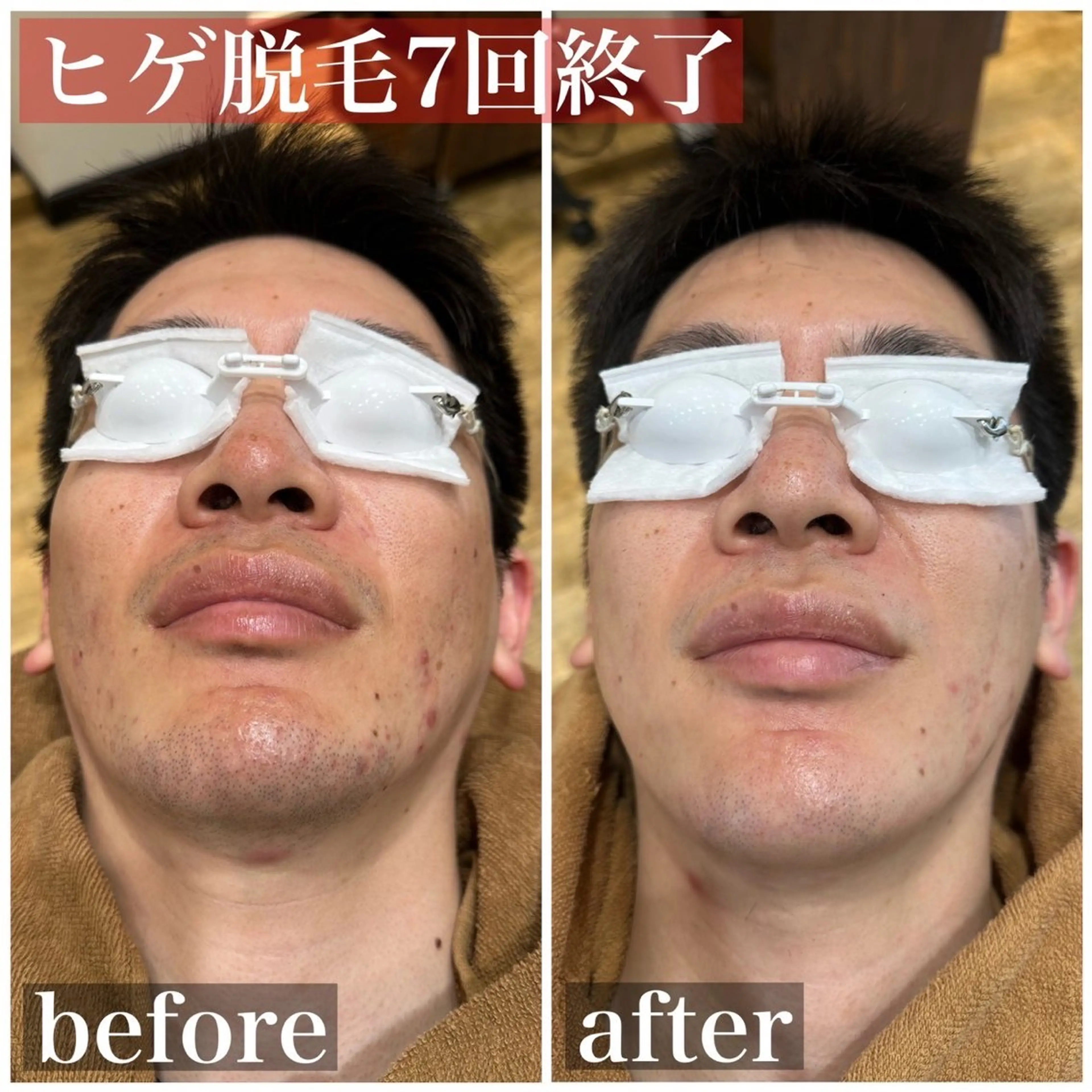 メンズ 脱毛 HAIRS YOSHIOKA所属・ヘアーズヨシオカ MENSヒゲ脱毛のエステ・リラクイメージ