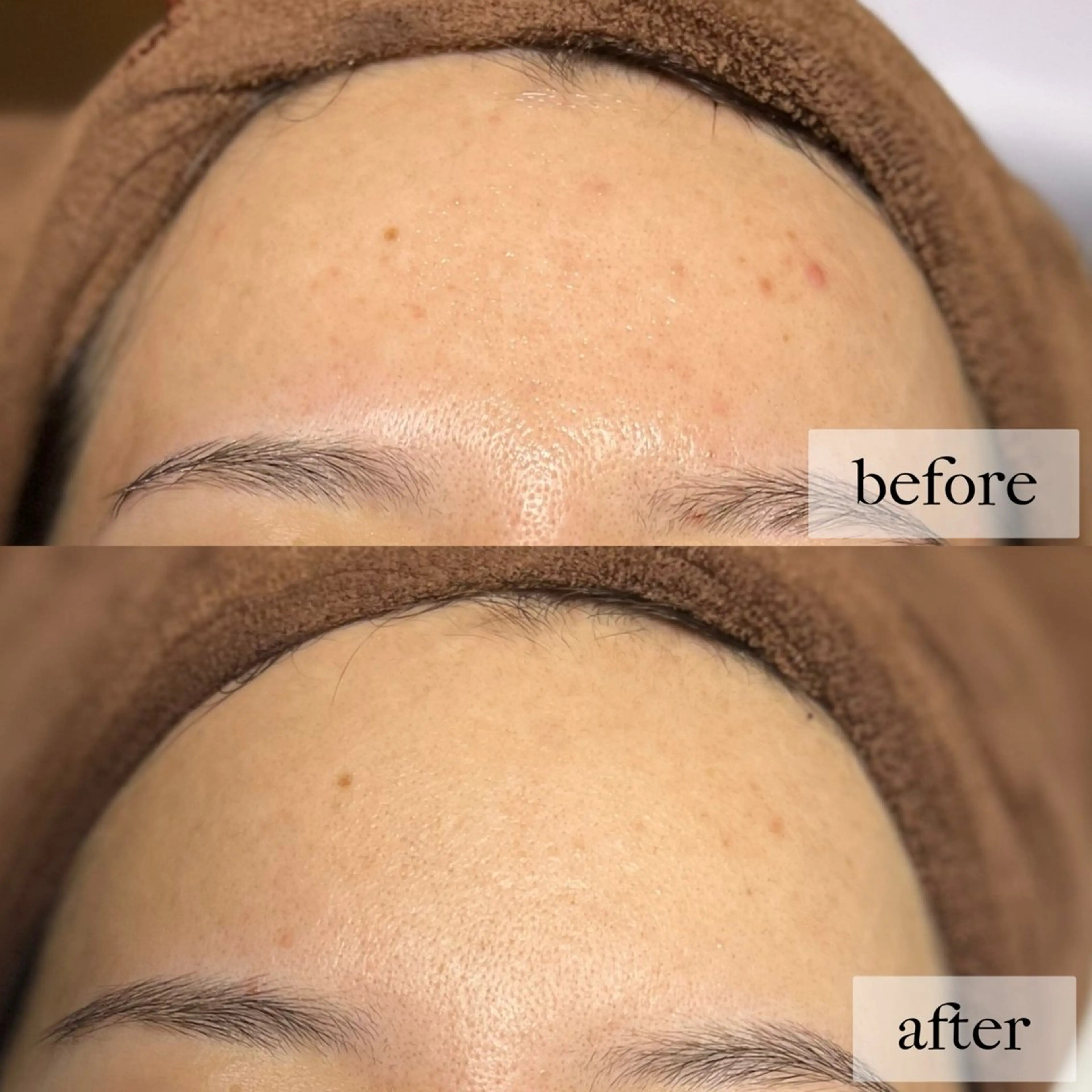 HINANO矢場町店【ヒナノ】所属・脱毛/肌改善🌿 HINANO 村田のエステ・リラクイメージ