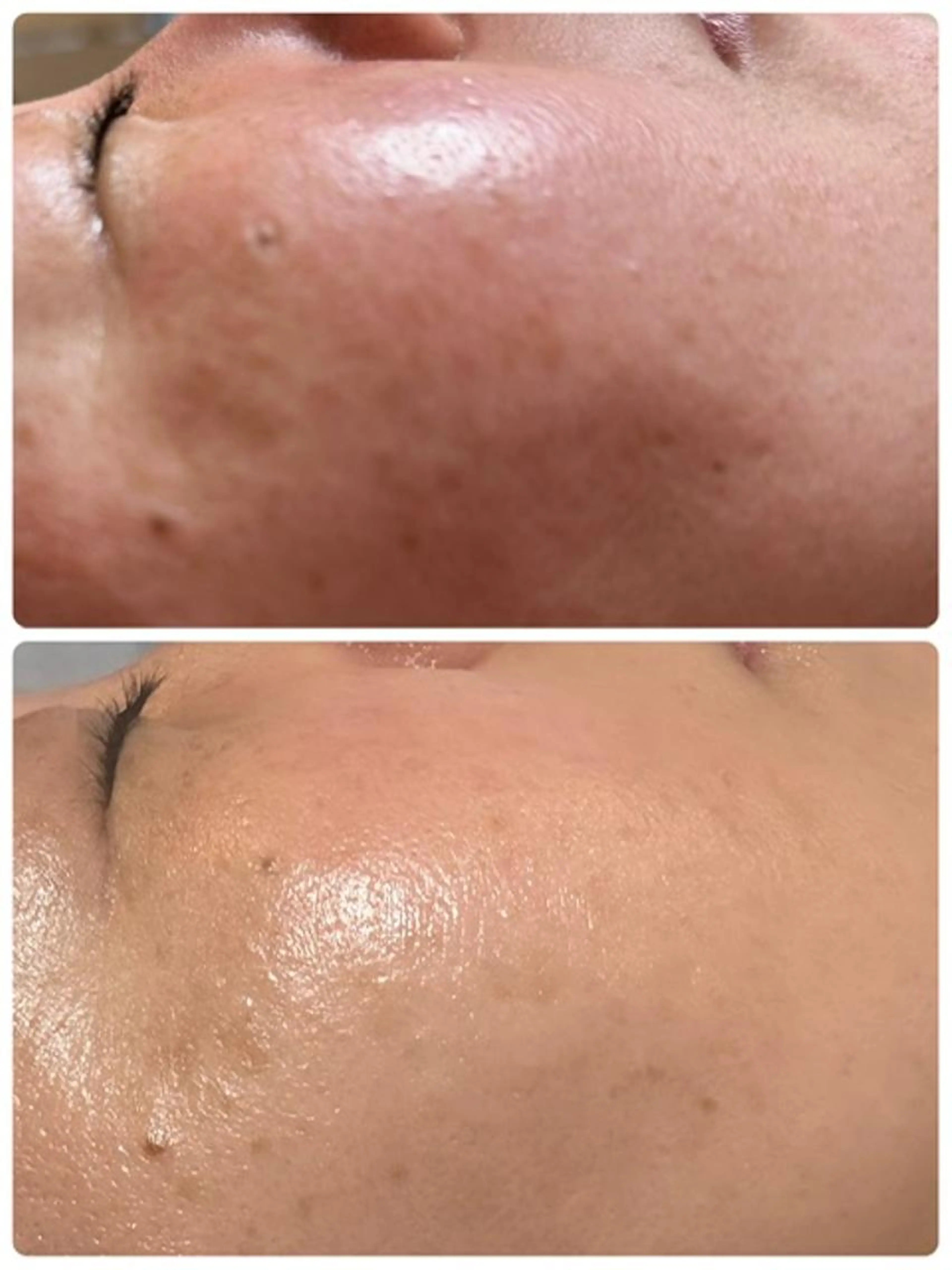 １回でお肌改善コース！毛穴、しわ、たるみ、小顔にケアできるコースの写真