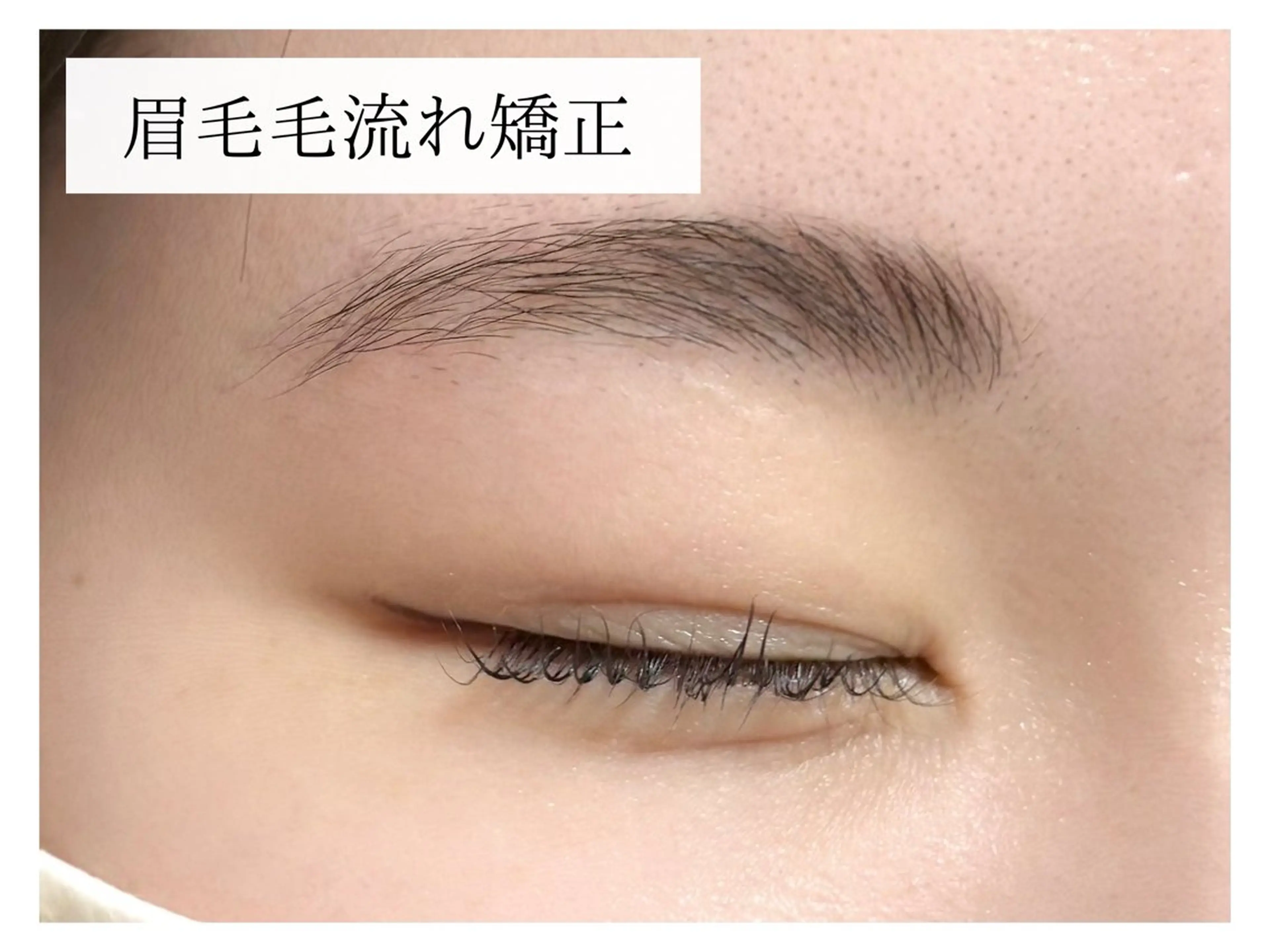 眉毛毛流れ矯正の写真