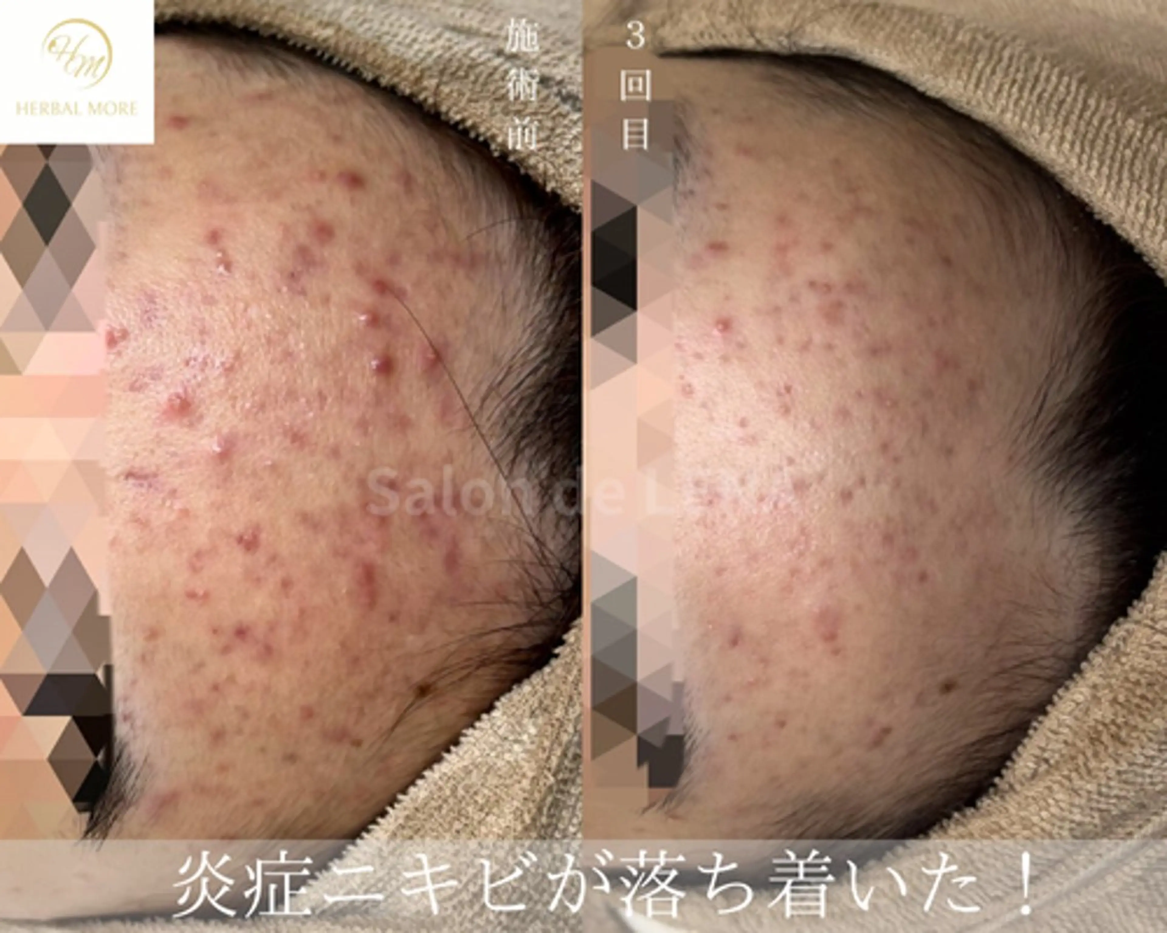 エステ サロンドレナ名駅店所属・ハーブピーリング専門 サロンドレナ平岡のエステ・リラクイメージ