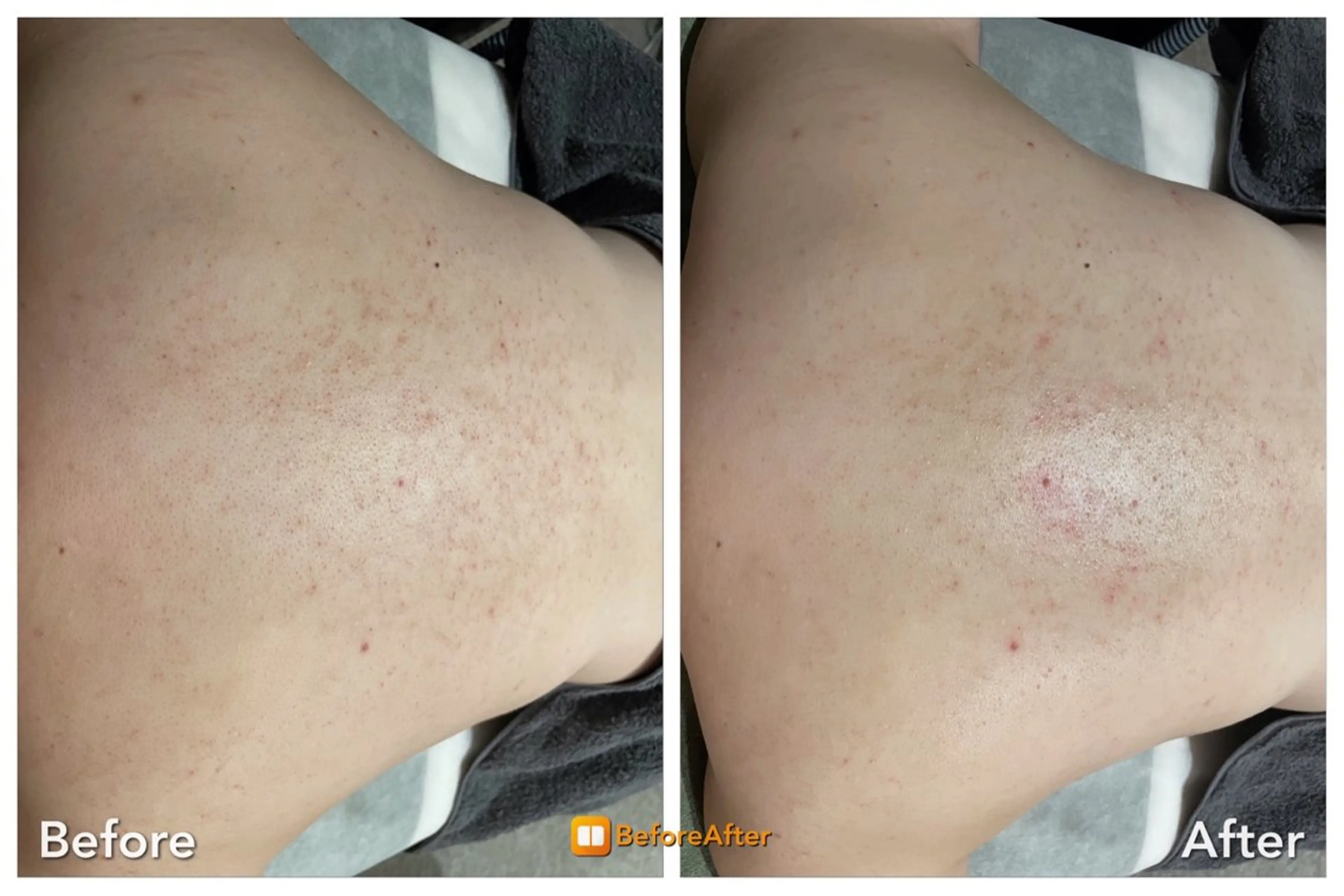 Meupニキビ専門店 背中/ハーブ/肌管理のその他イメージ