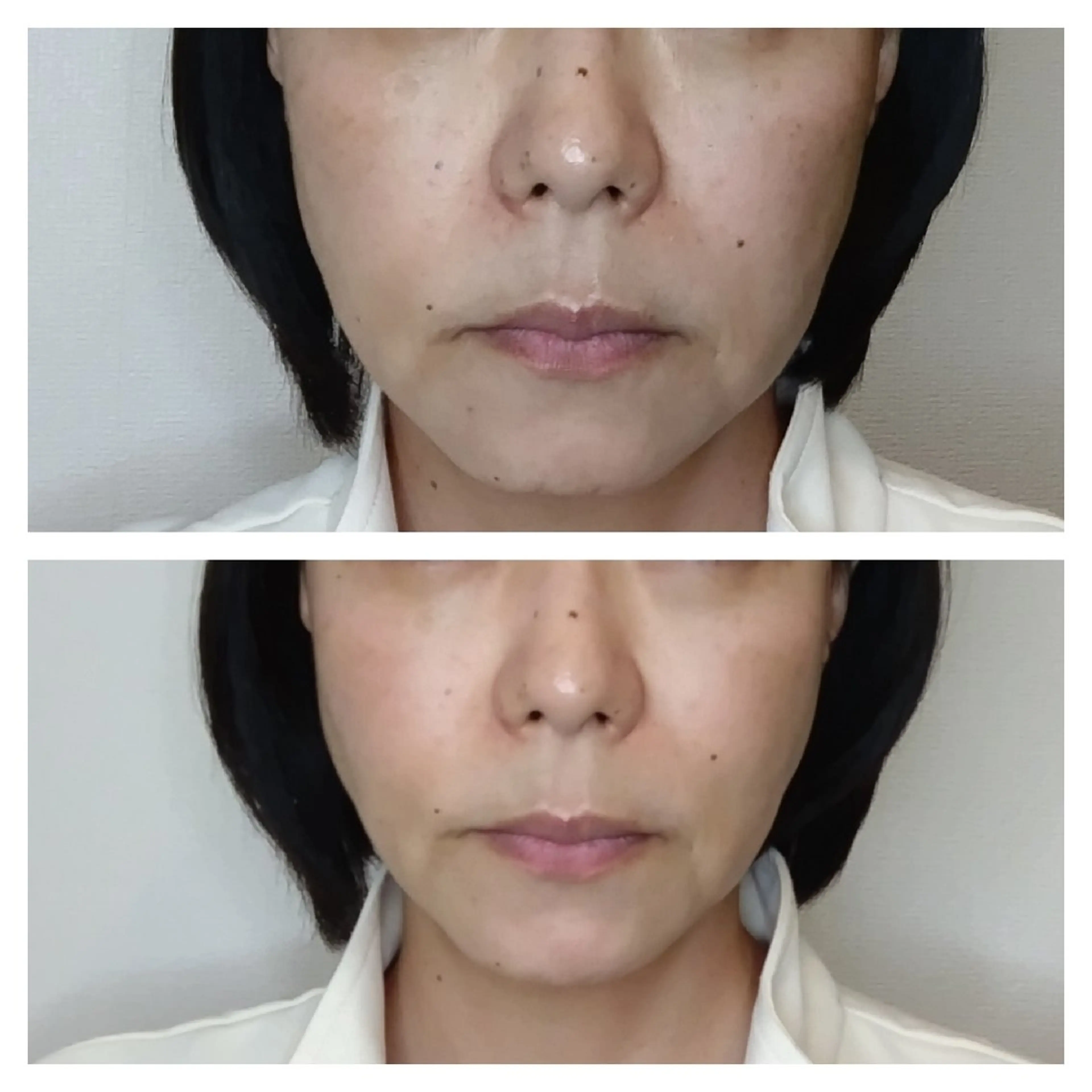 ✴️期間限定📣最新機器サーマトリックスで小顔💆ニキビ跡凹凸肌も改善✨シートマスク付き☝️の写真