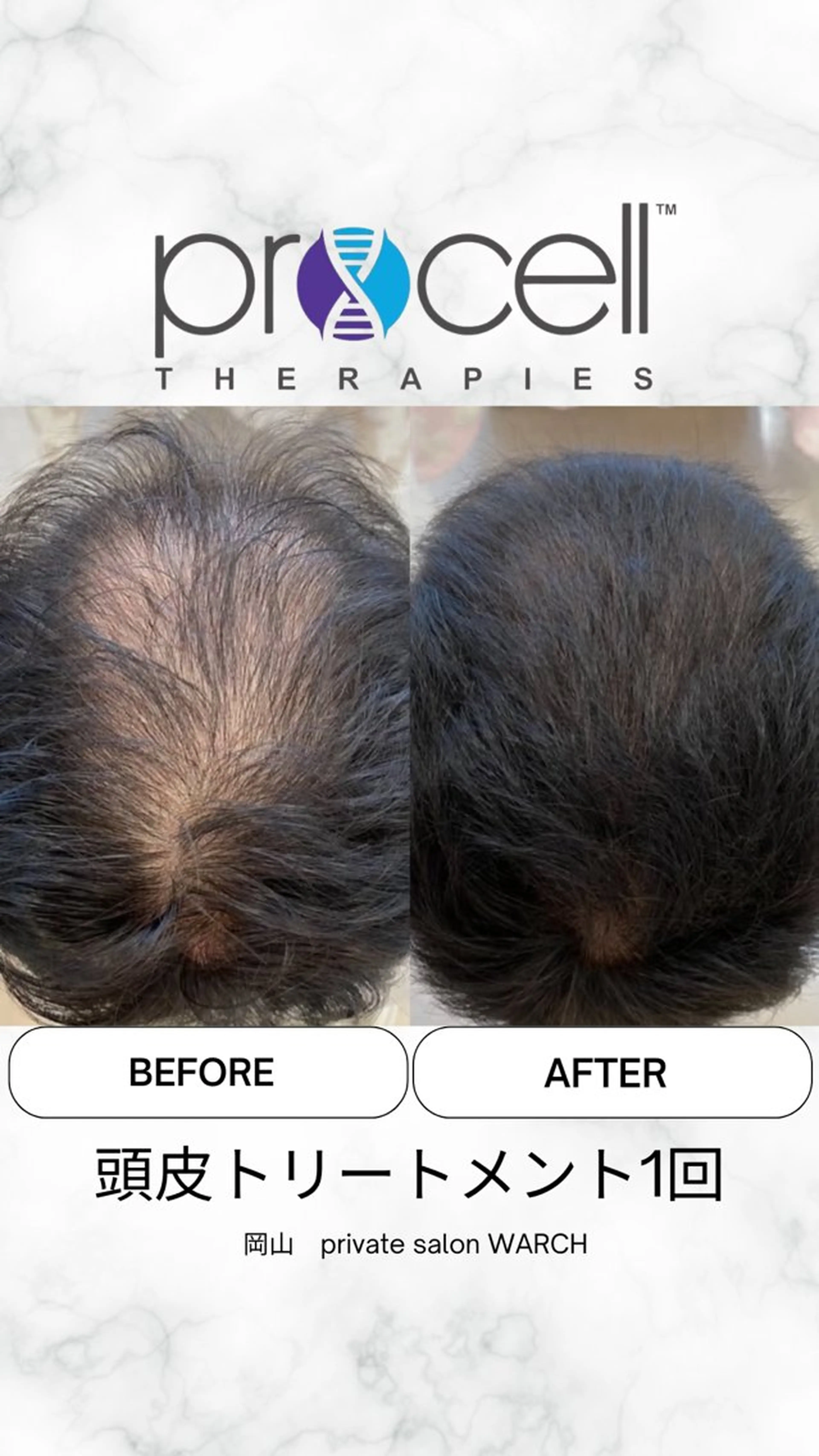 【本気の育毛促進】プロセル頭皮（頭頂部、円形の抜け毛）￥50,000→￥40,000の写真