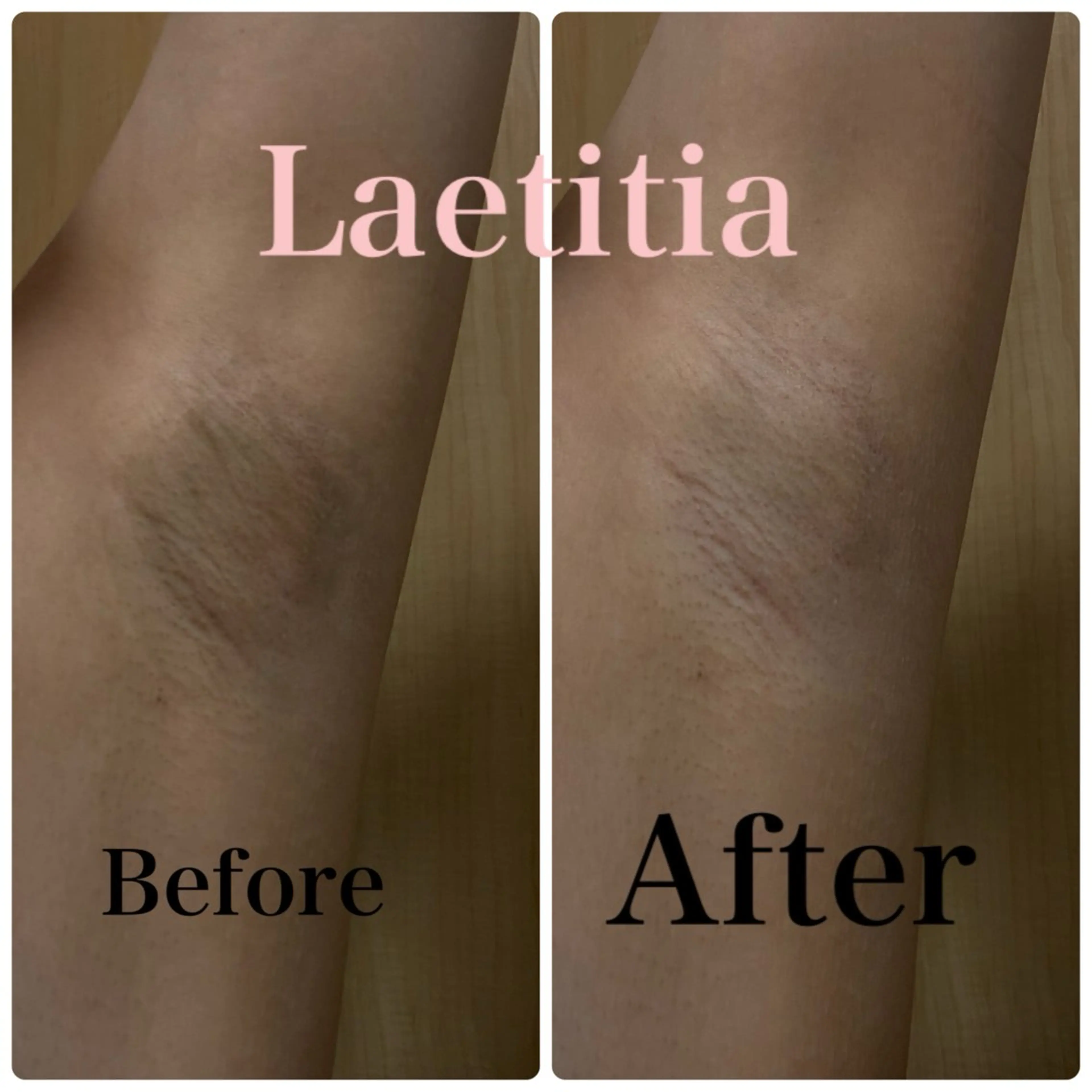 【特別キャンペーン価格✨1/31まで】ローマピンク🌸「Vライン、Oライン、脇、肘、膝、お尻」の写真