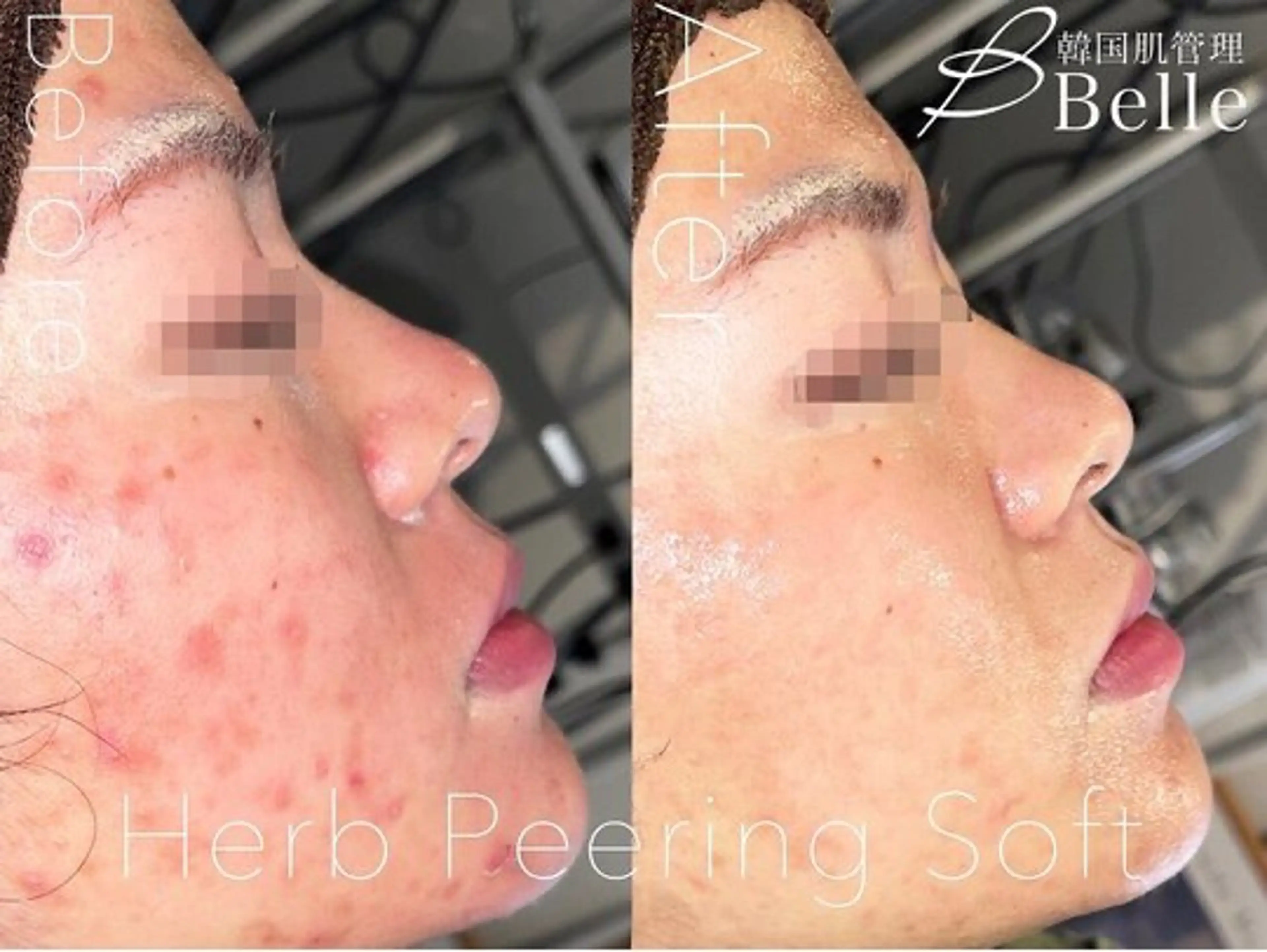 ハーブピーリング🌿 asukaのエステ・リラクイメージ