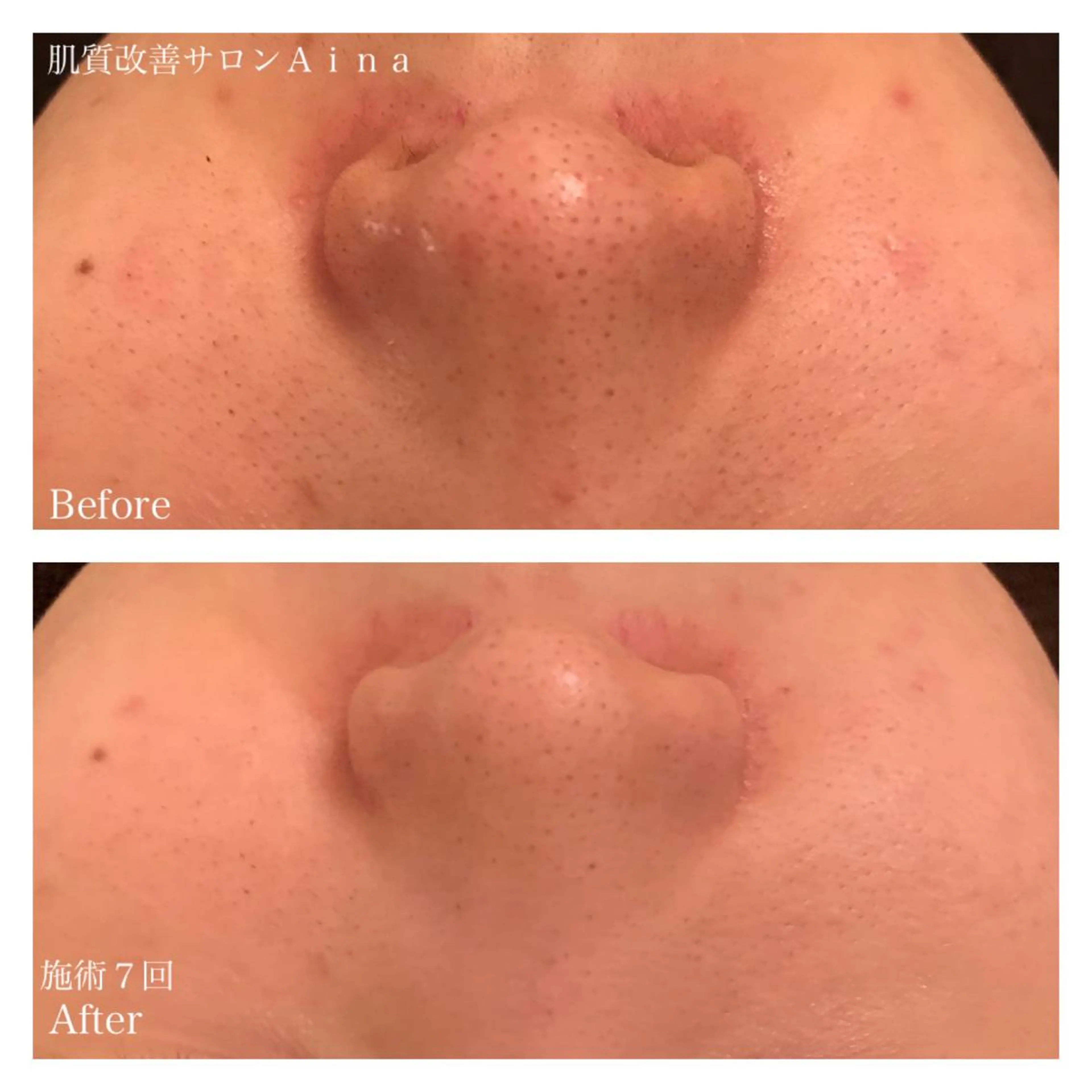 ミディアム パーマ キッズ ネイル マツエク・マツパ ニキビ跡専門サロン Ａｉｎａのエステ・リラクイメージ