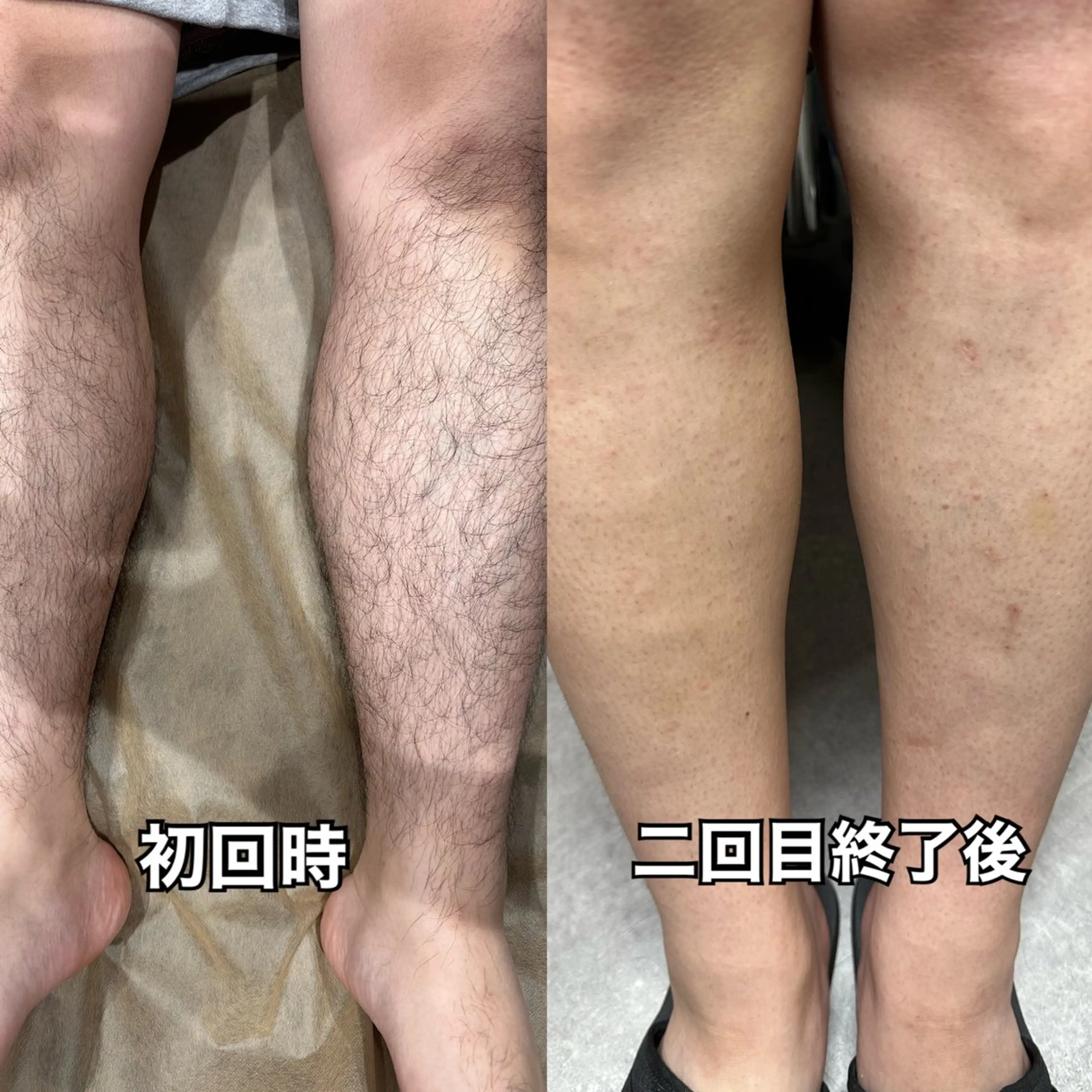 初回限定　メンズ　下半身脱毛（VIO込み）通常都度払い11000円→4400円の写真