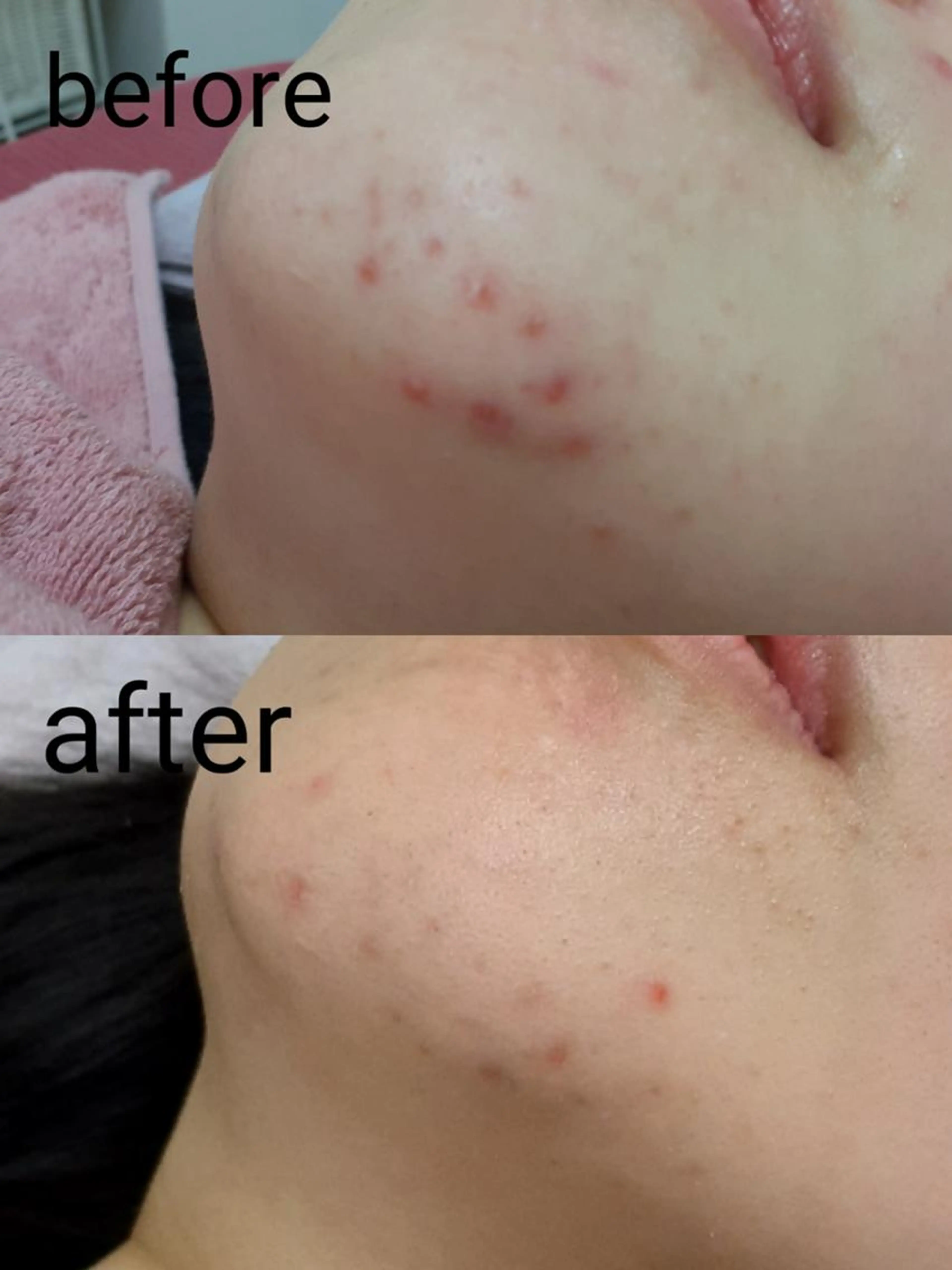 【黒毛穴×ニキビケア】大人気！全顔毛穴洗浄+スーパービタミンC微弱電流導入+ミニモ限定高保湿クリーム¥5500の写真