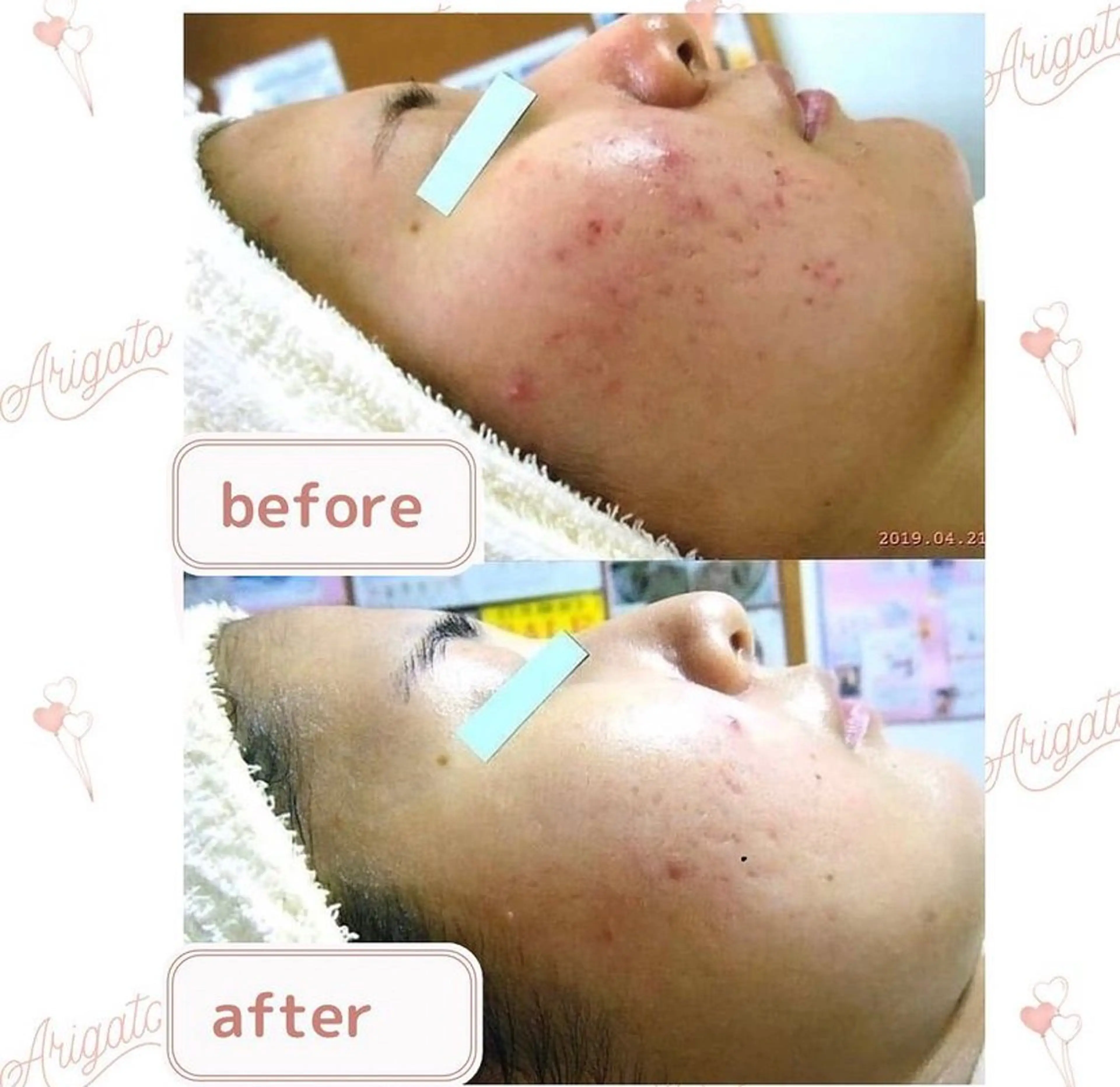 ニキビケア◇ニキビ跡 レゾン京橋店　八崎のエステ・リラクイメージ