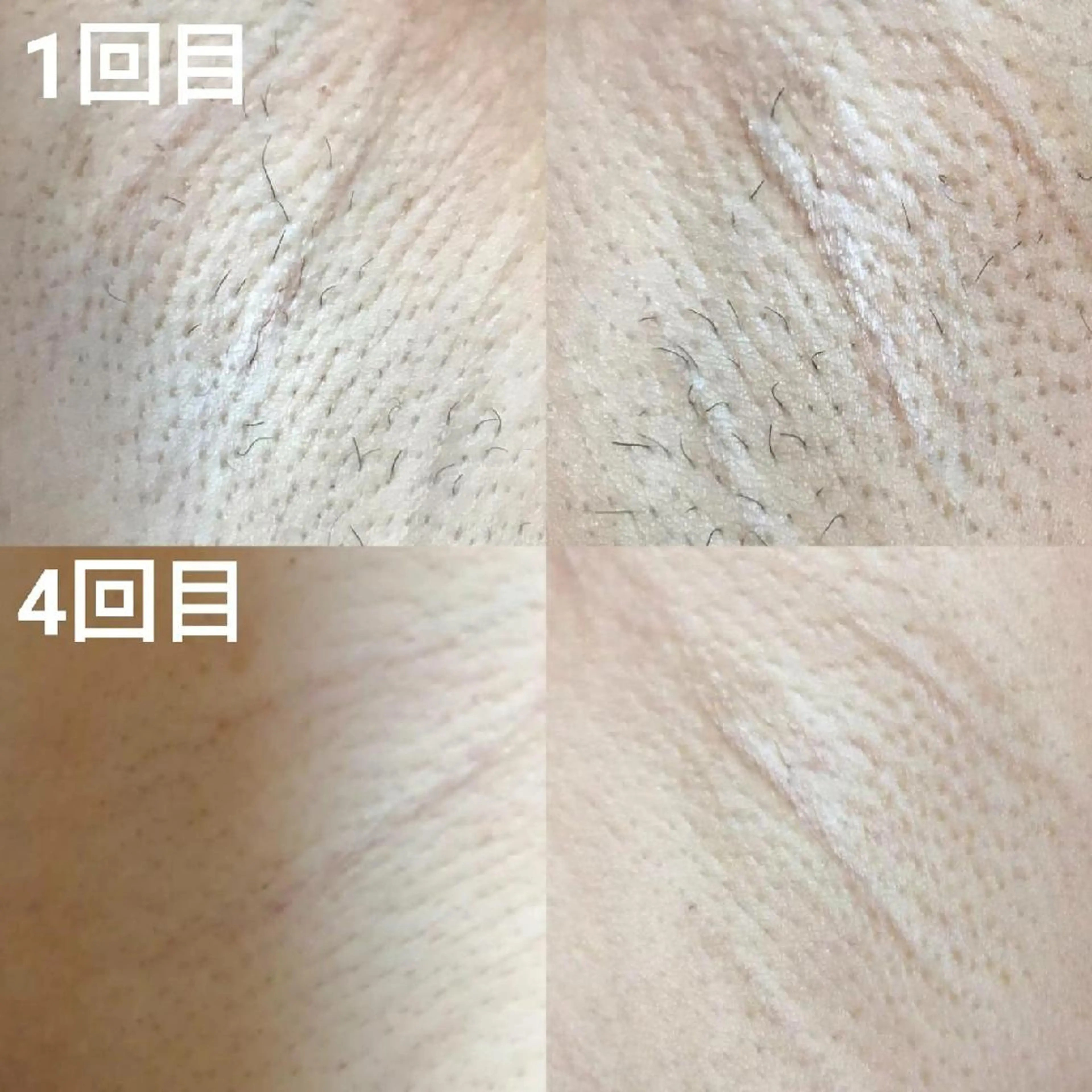 【ワキ脱毛】一番気になる人気NO.1部位⭐️の写真