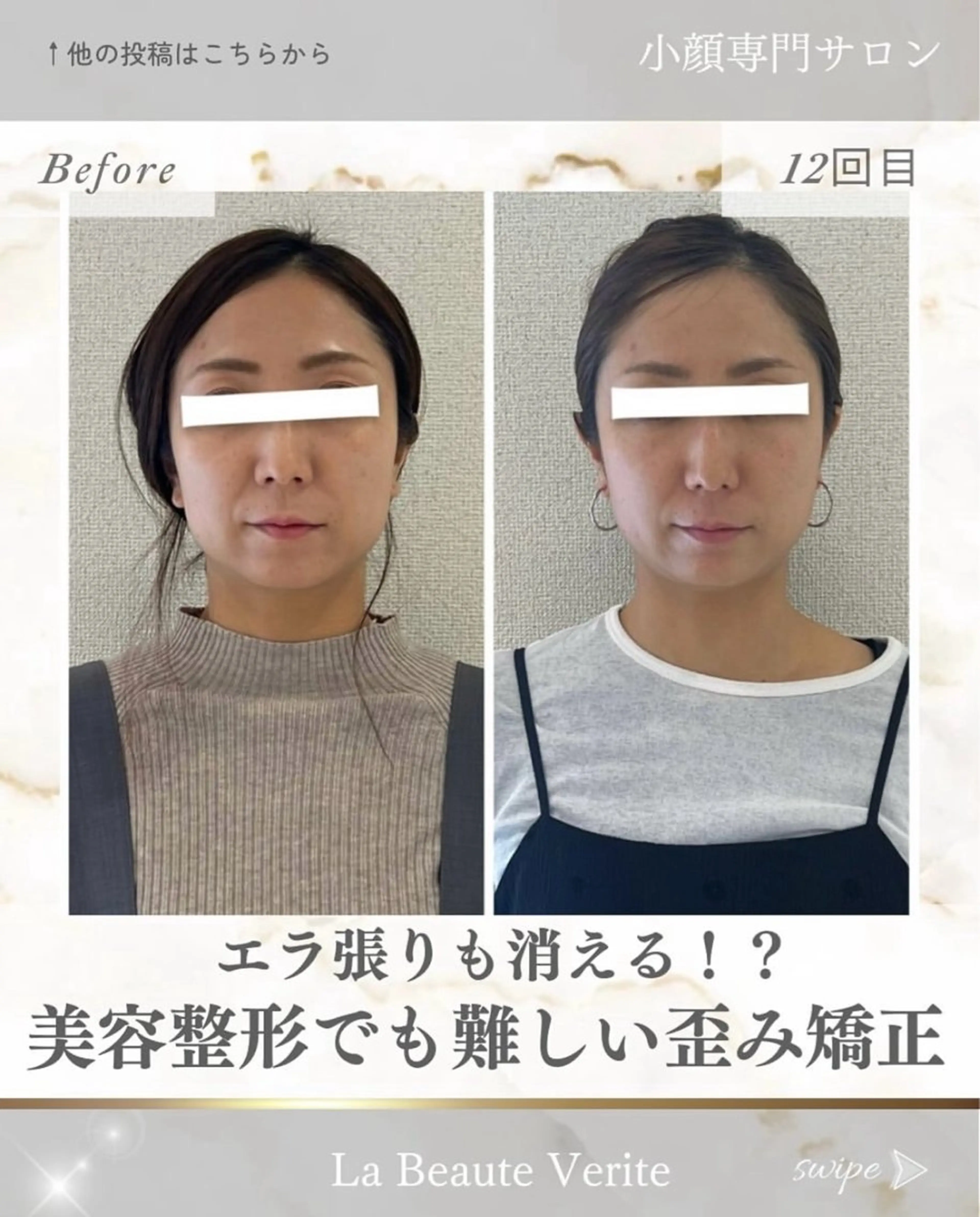 糸リフトいらずリフトアップ小顔矯正 初回体験の写真