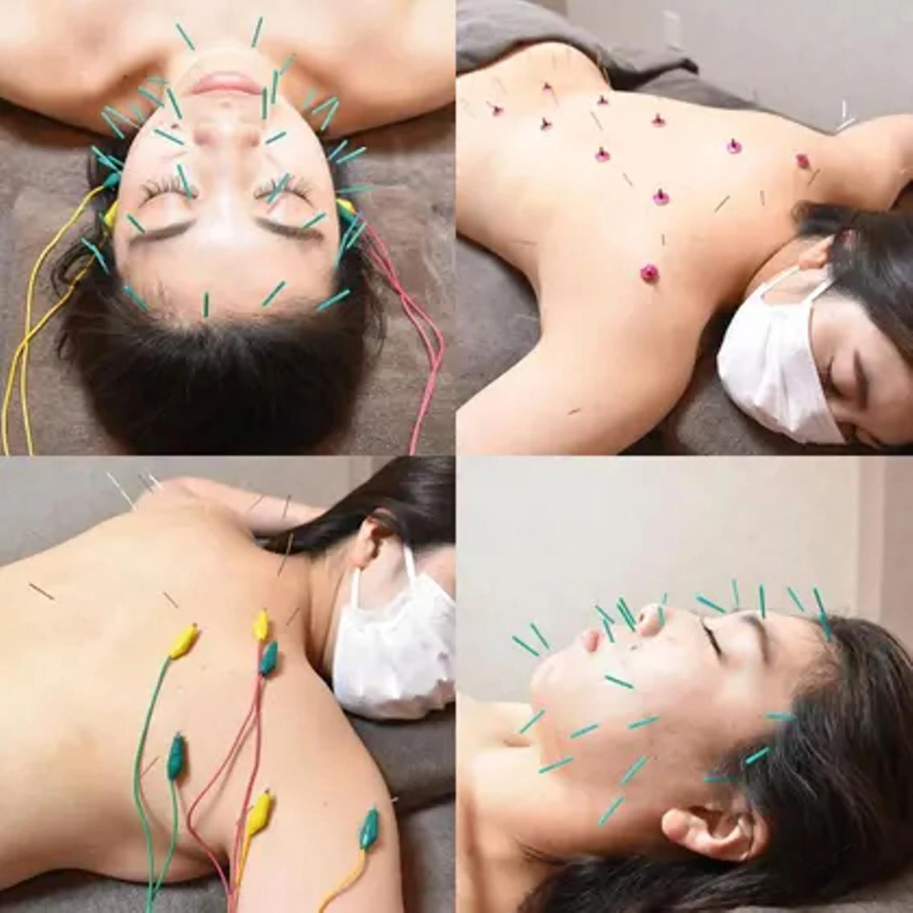 【新規】美顔/美容はりトータルケア90分¥17600→¥8990　　《はりきゅう/美顔はり/整体組合せ》の写真