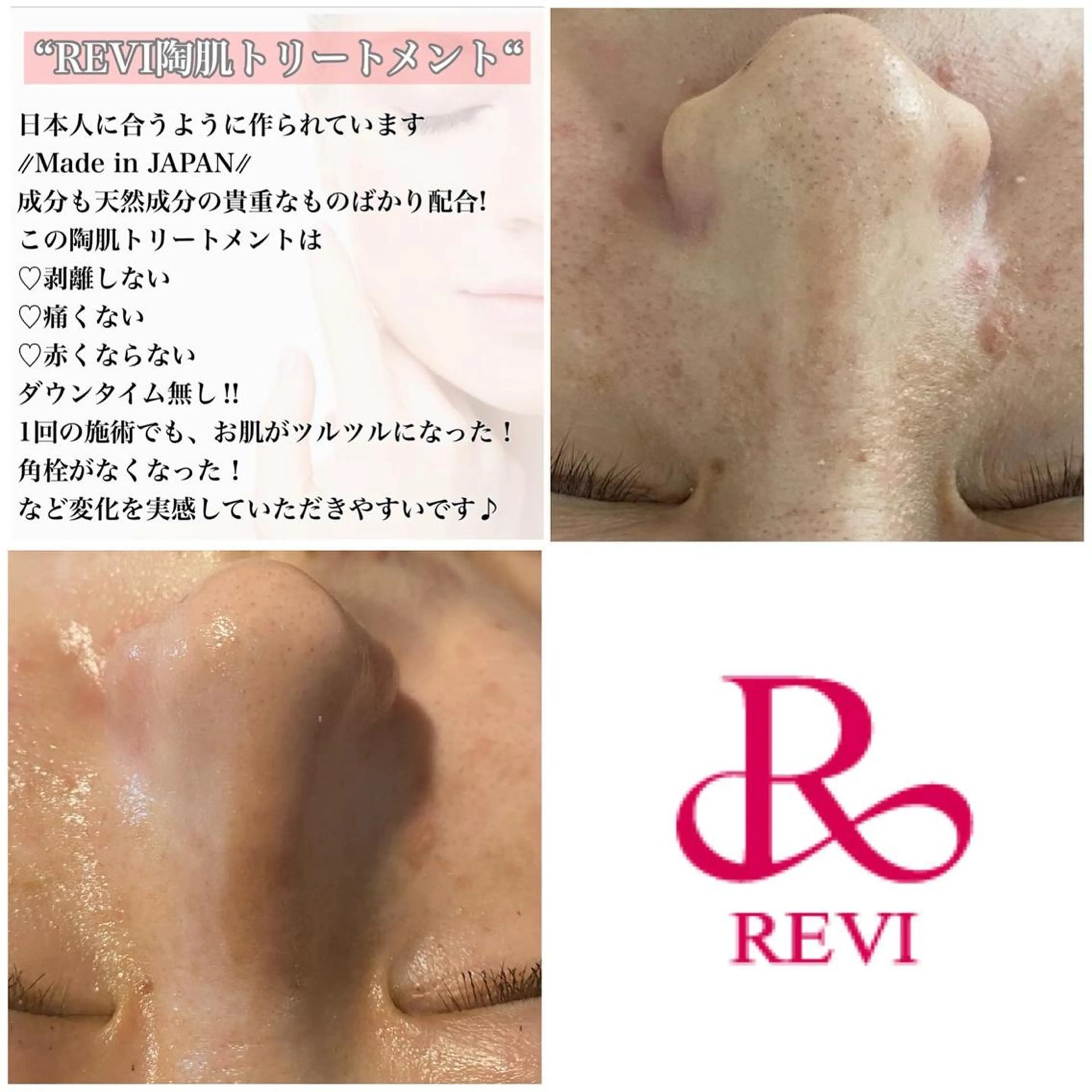 エステ Chalon所属・REVI取扱・肌悩み 毛穴Chalonのエステ・リラクイメージ