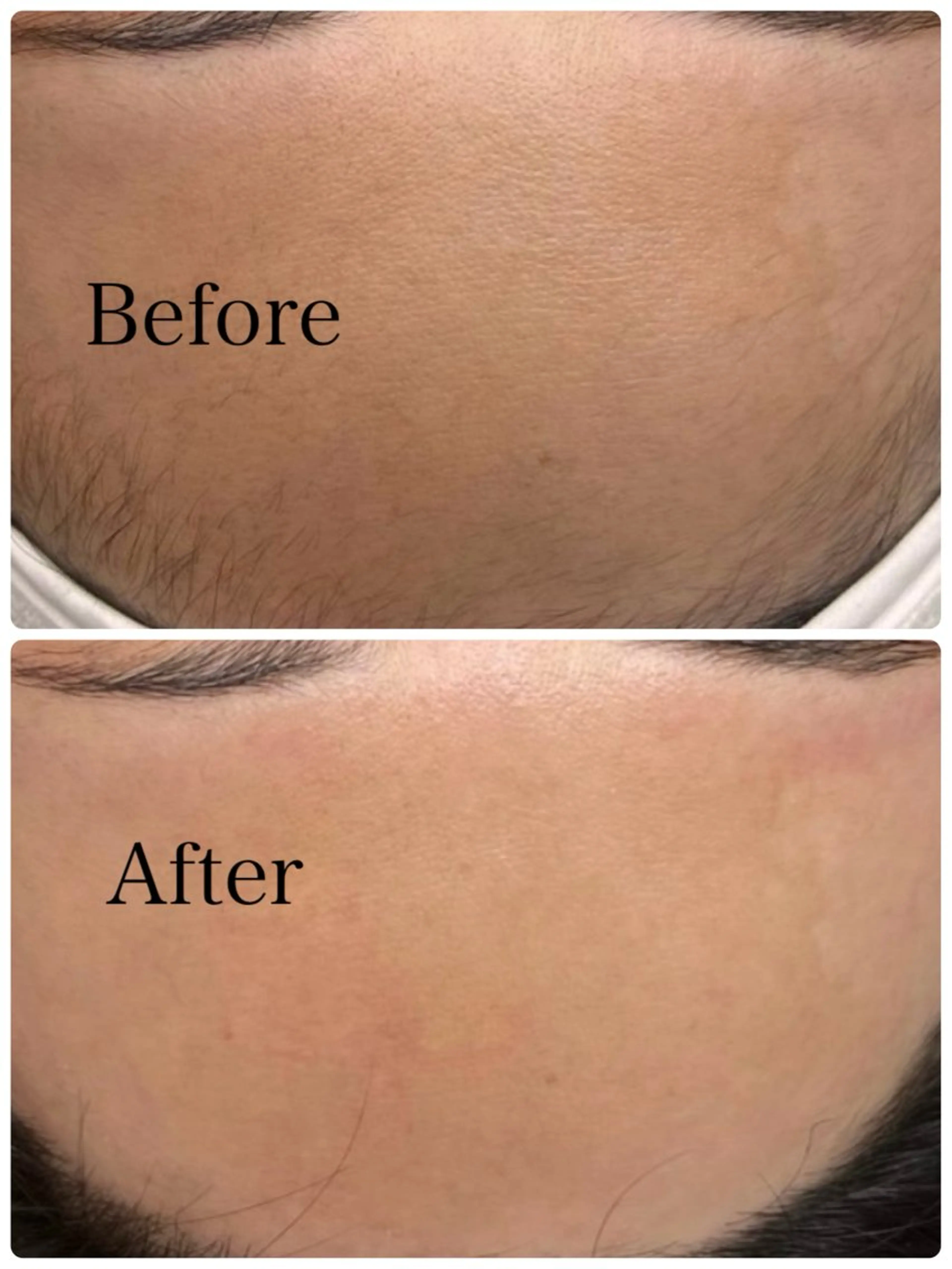 ツルツル美肌✨フェイシャルワックス(全顔)の写真