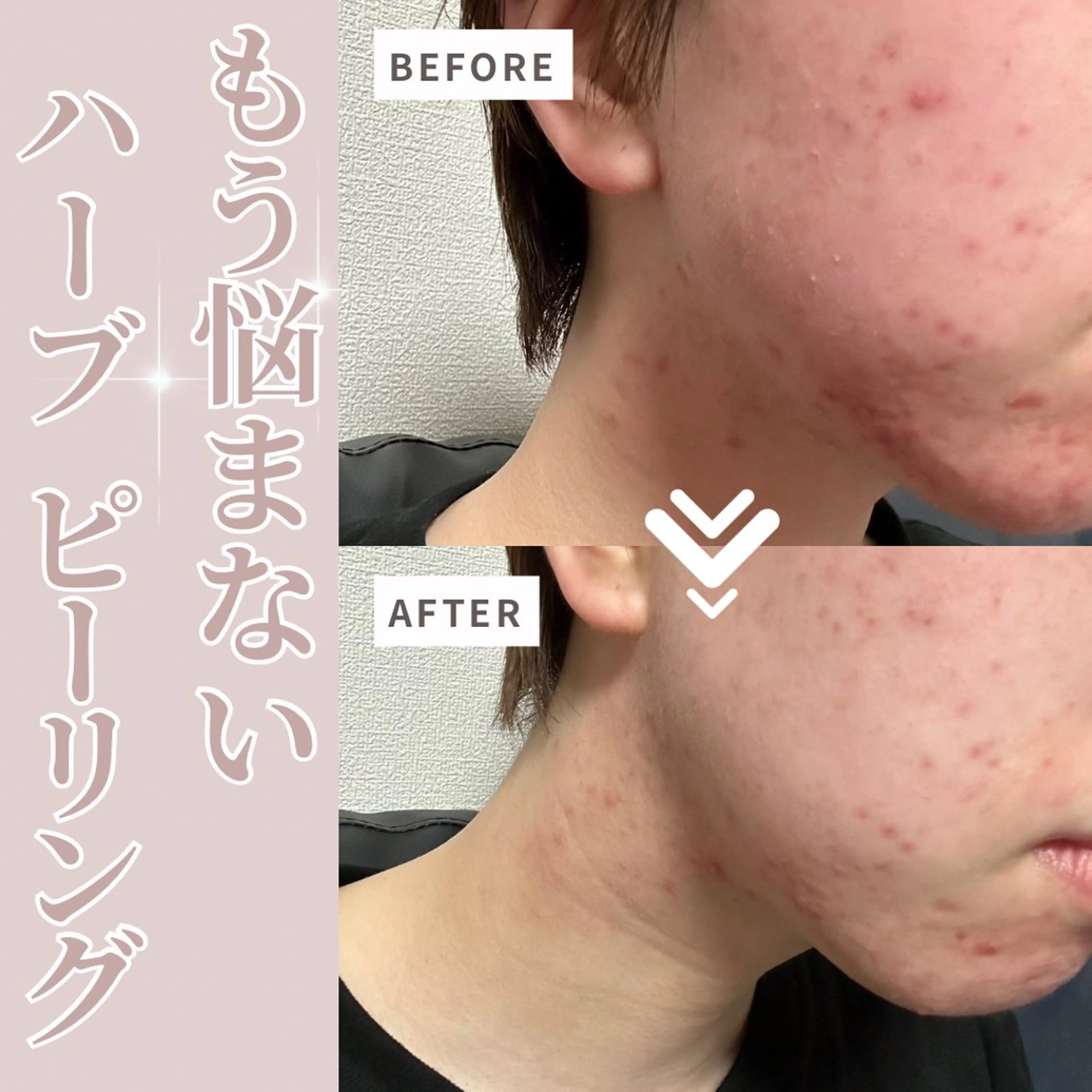 ミニモ価格✨リベルハーブピーリングの写真