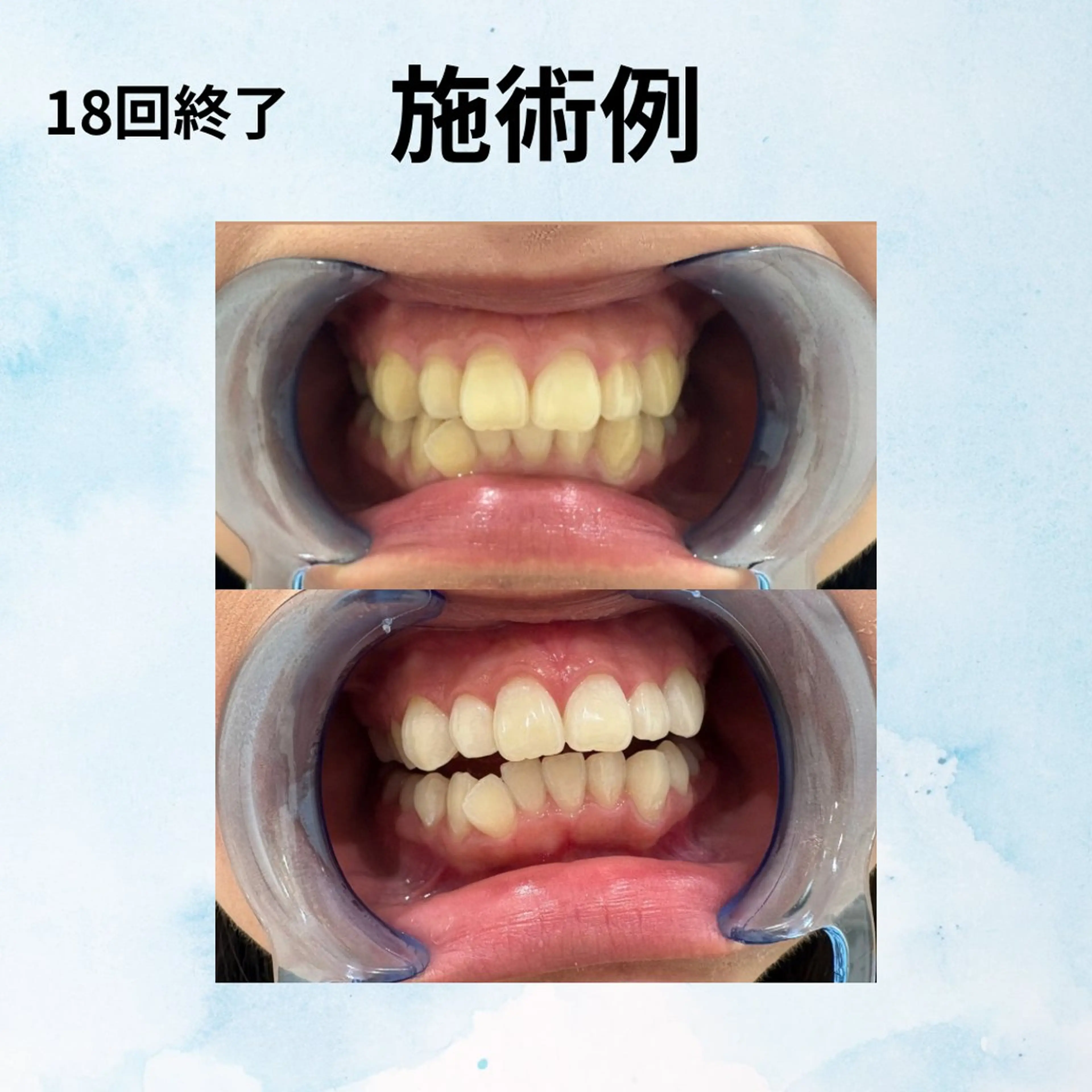 Ocpis博多店ホワイトニングサロン所属・ホワイトニングサロン Ocpis品川 慶仁のその他イメージ