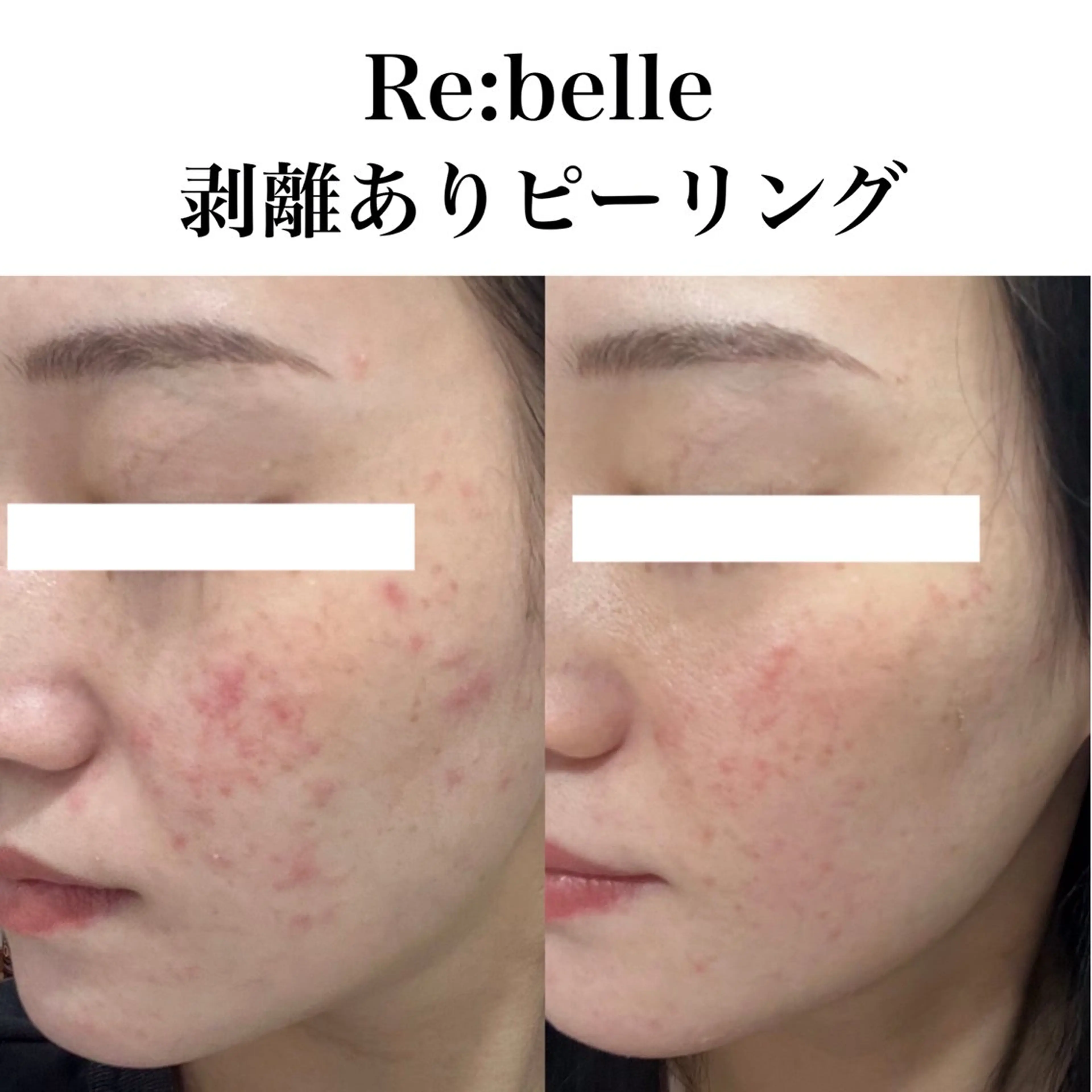 【1回大変化!医療機関提携】剥ける！ハーブピーリング☆幹細胞美容液付き☆の写真