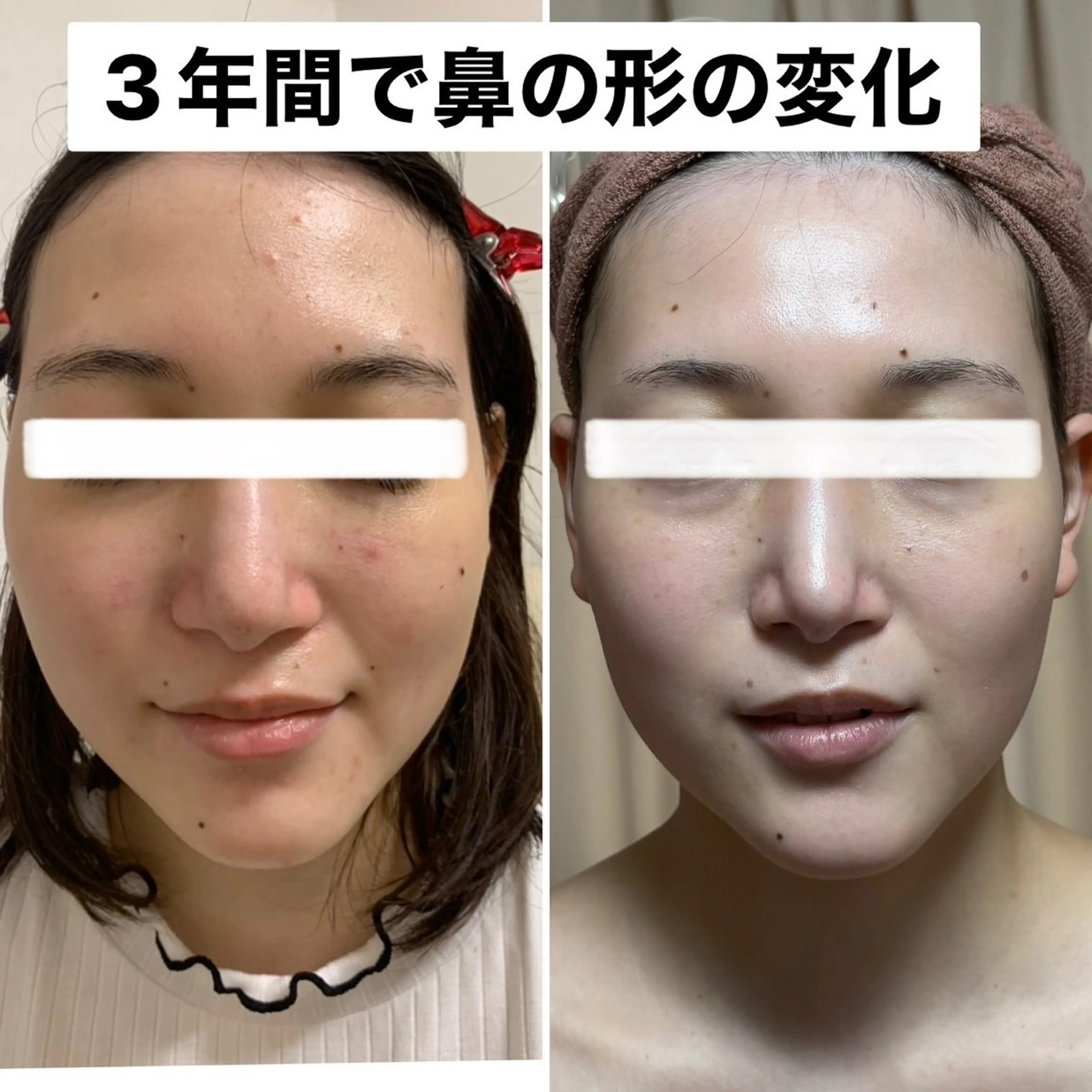 ❤️フェイスラインや二重顎気になる方❤️《小顔効果はもちろん、表情筋動かして綺麗な笑顔にーの写真