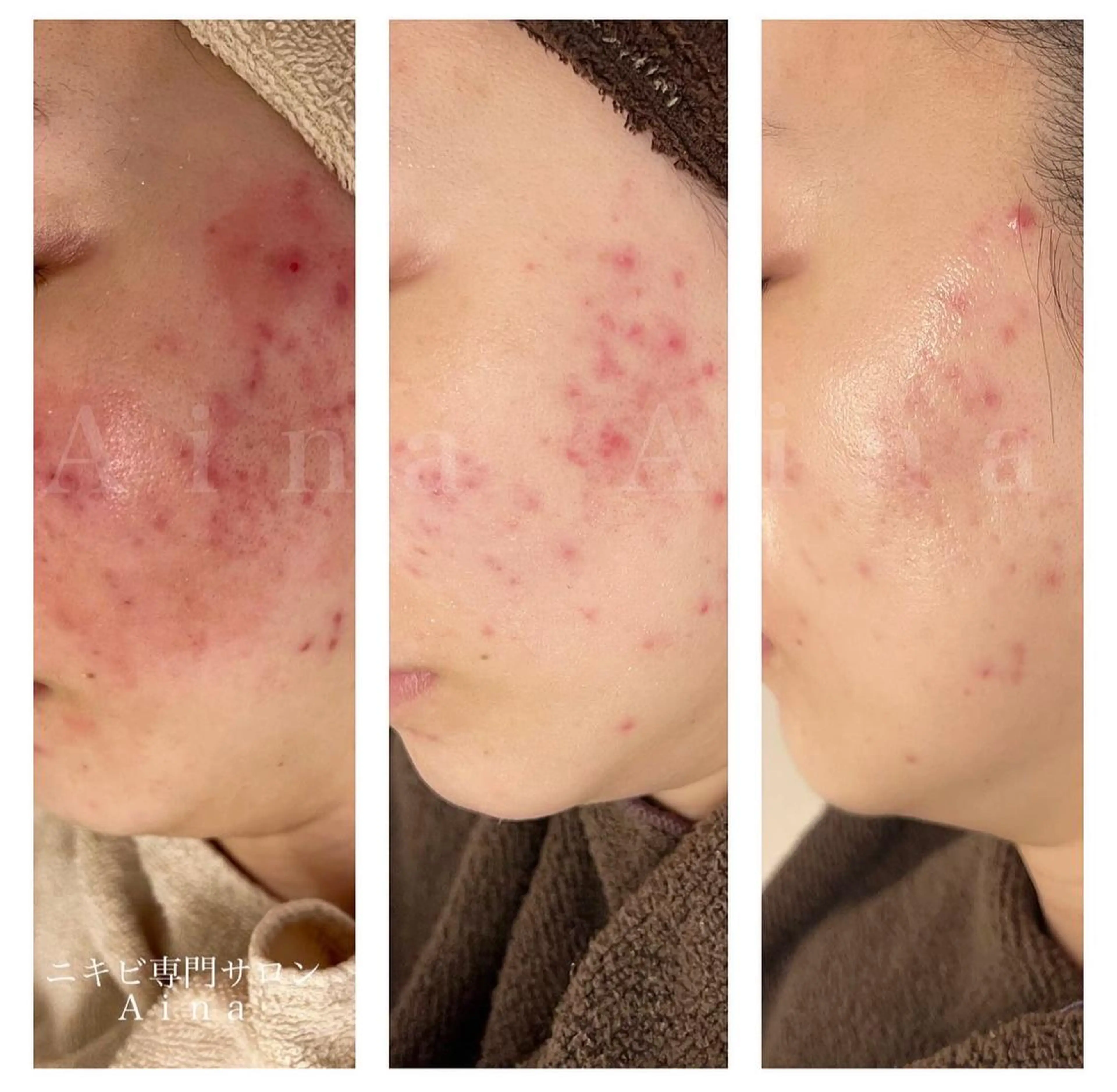 セミロング パーマ ヘアアレンジ メンズ キッズ ネイル マツエク・マツパ アイブロウ 赤色 エステ リラク ニキビ跡専門サロン Ａｉｎａのエステ・リラクイメージ