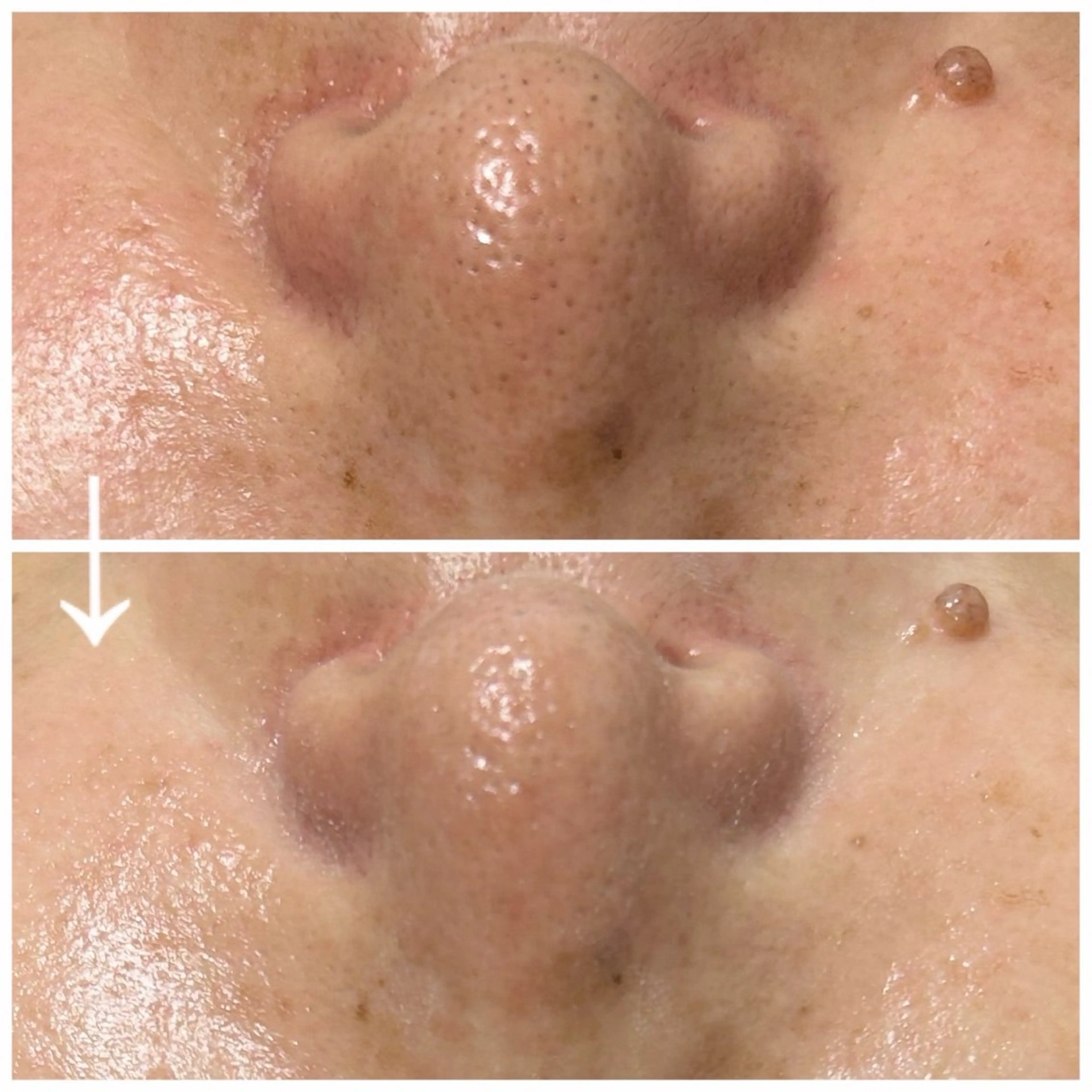 毛穴徹底洗浄エステの写真